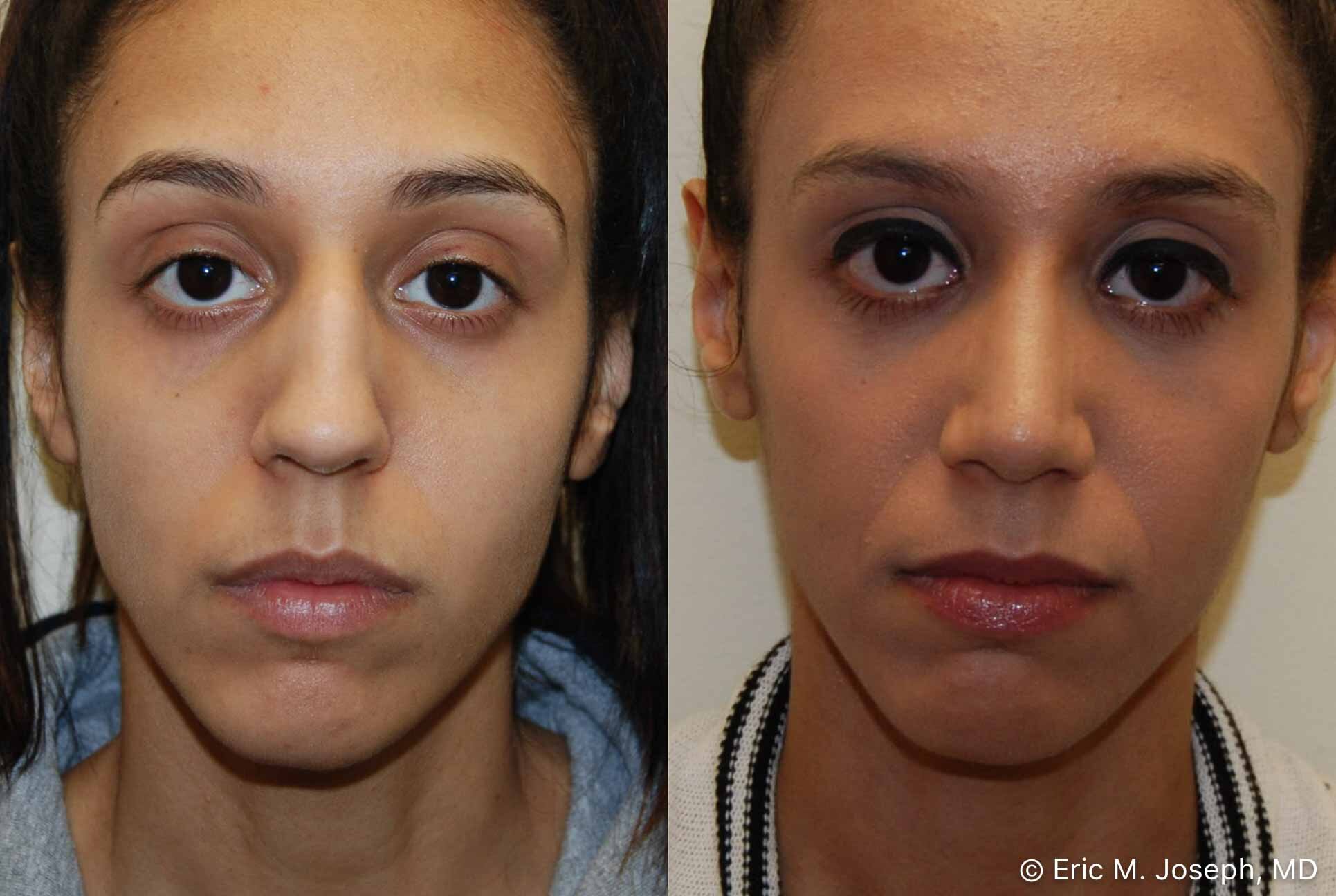 rhinoplasty-nj-nose-job-new-jersey-0565.jpg