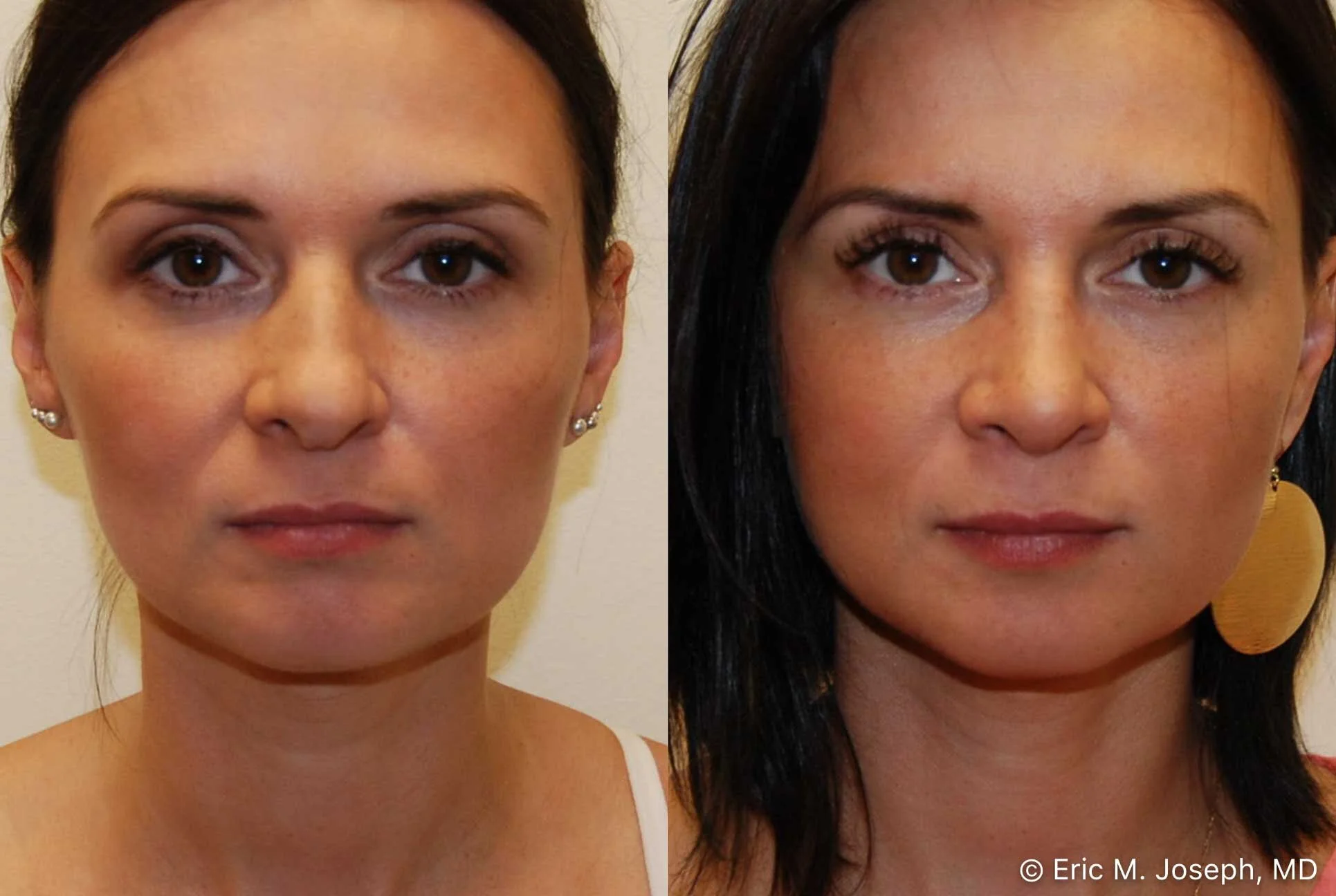 rhinoplasty-nj-nose-job-new-jersey-0580.jpg