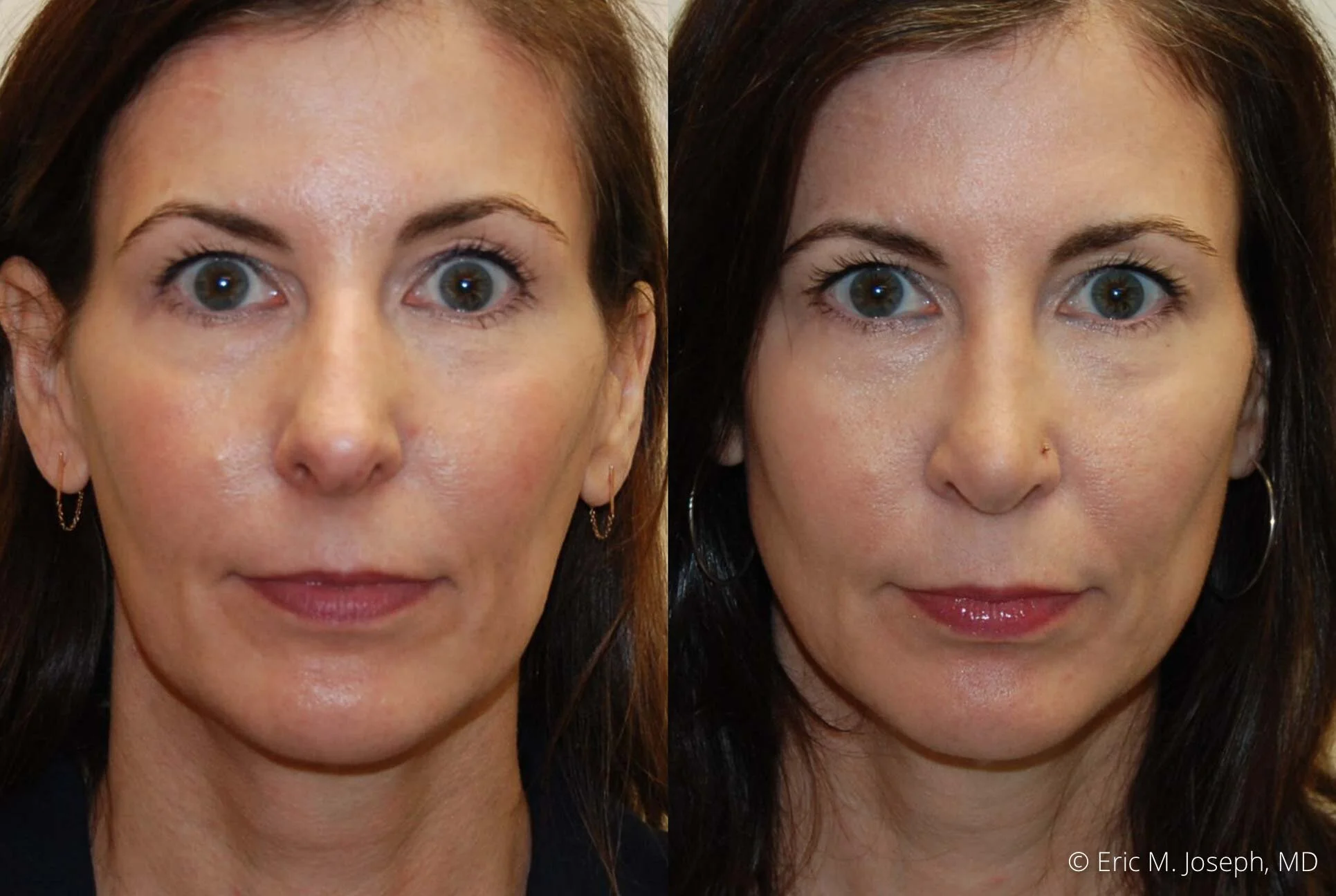 rhinoplasty-nj-nose-job-specialist-0505.jpg