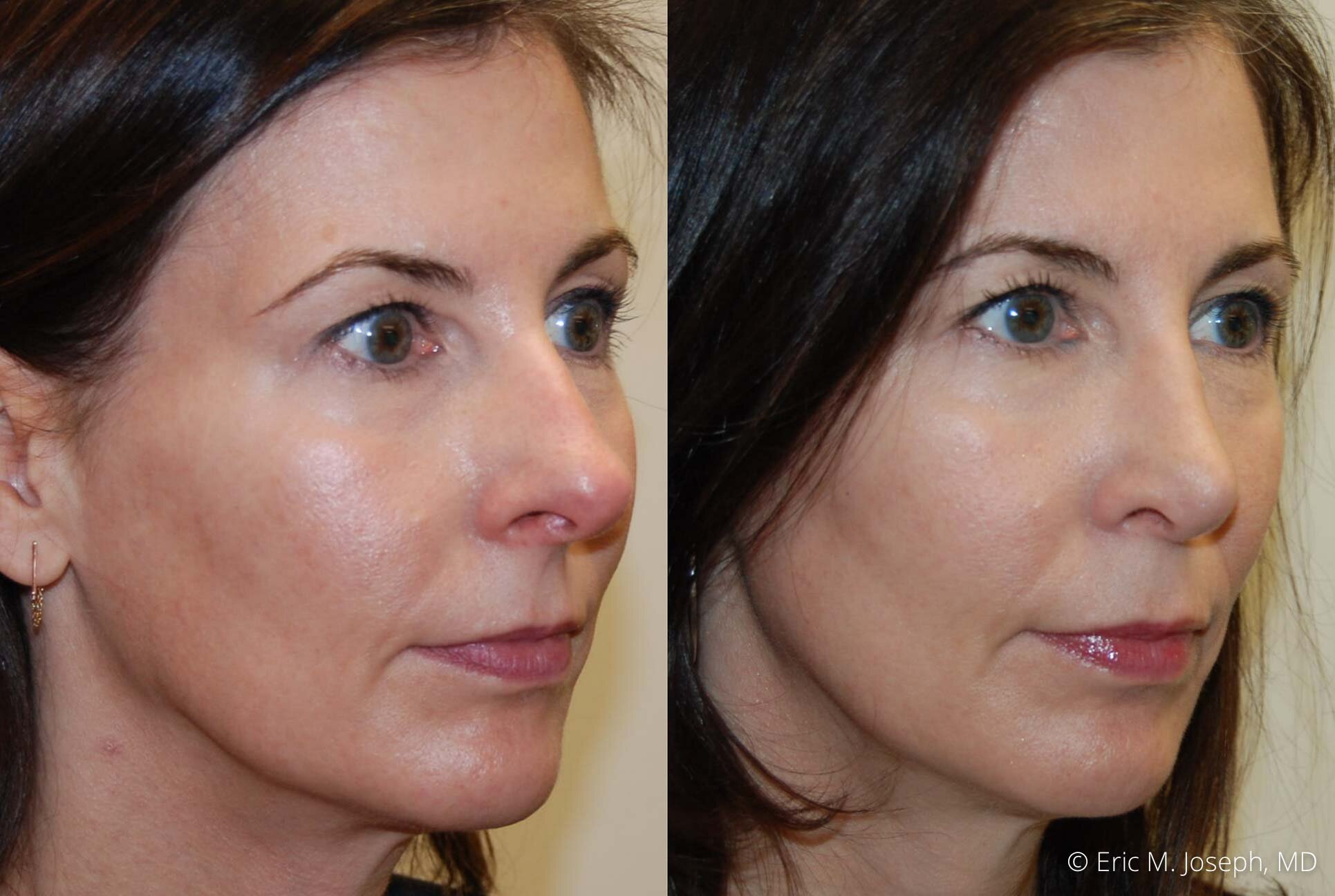 rhinoplasty-nj-nose-job-specialist-0507.jpg