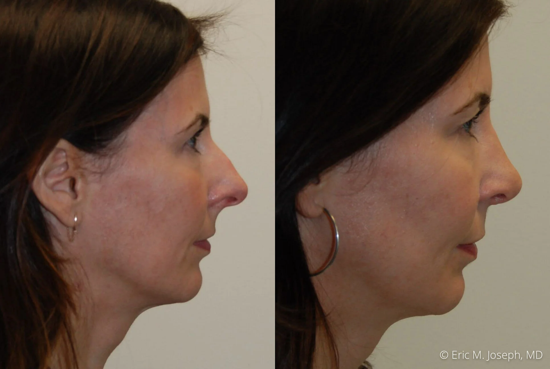 rhinoplasty-nj-nose-job-specialist-0509.jpg