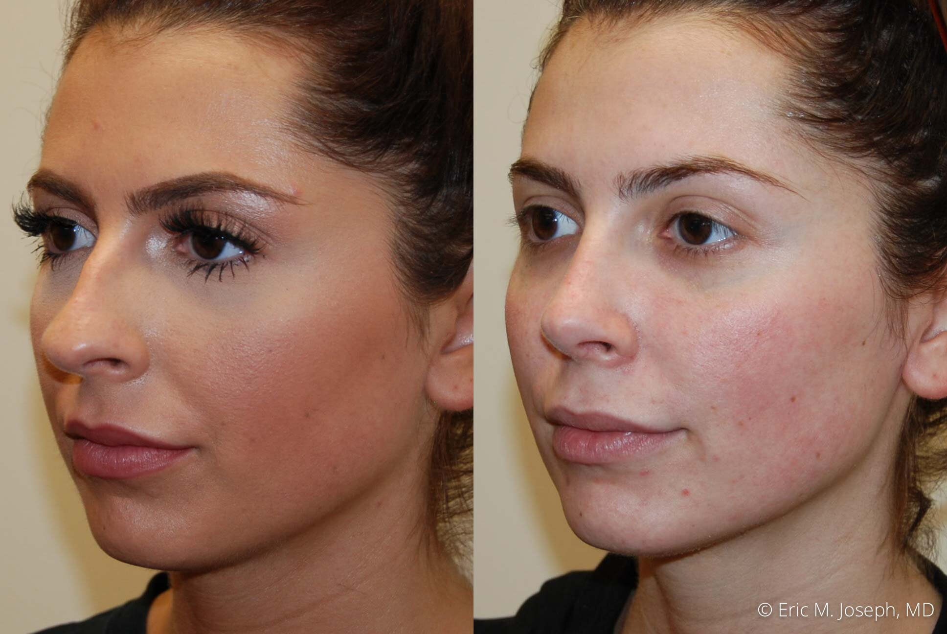 rhinoplasty-nj-nyc-nose-job-0375.jpg