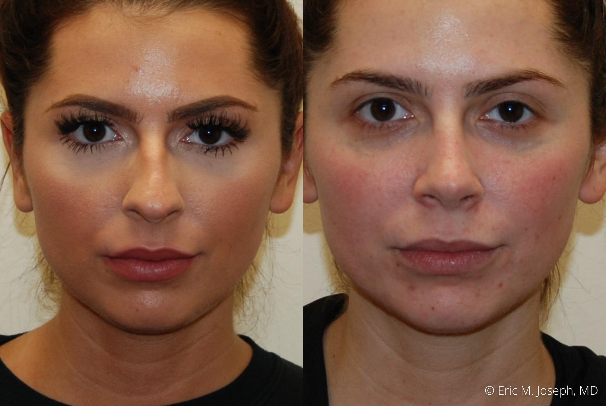 rhinoplasty-nj-nyc-nose-job-0377.jpg