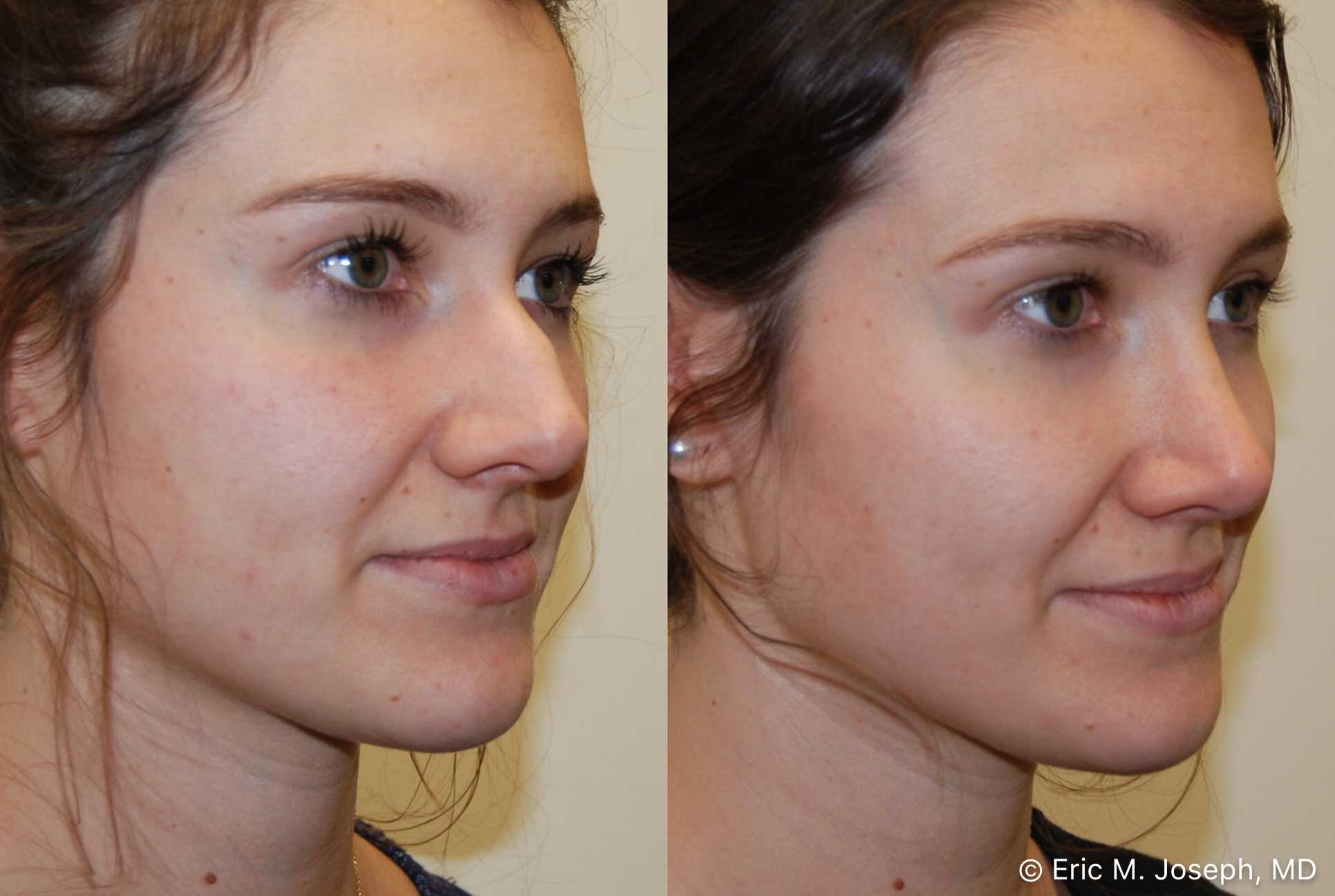 rhinoplasty-nj-nose-job-new-jersey-0571.jpg