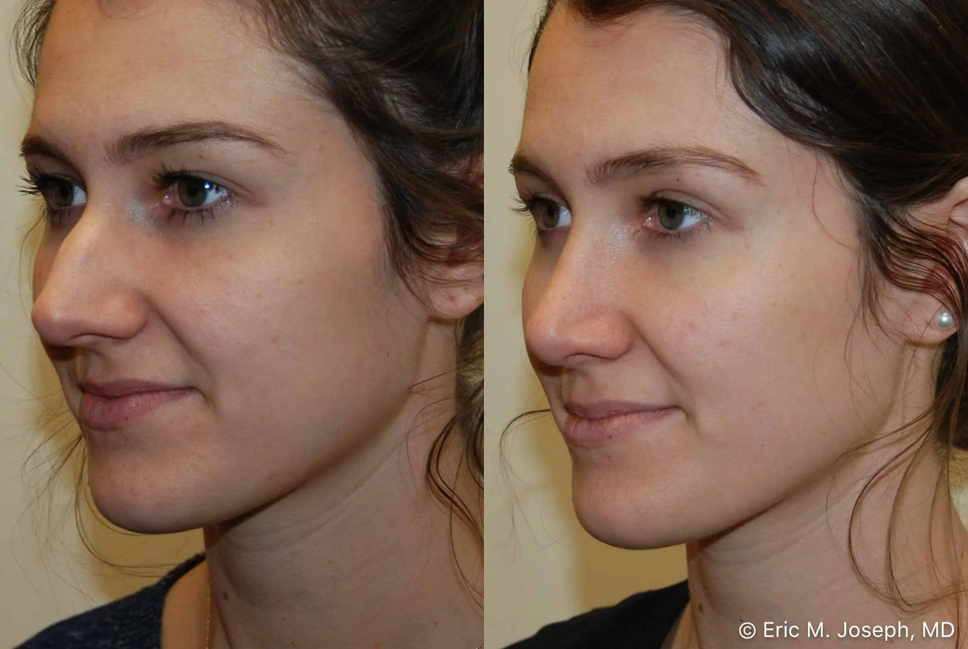 rhinoplasty-nj-nose-job-new-jersey-0572.jpg