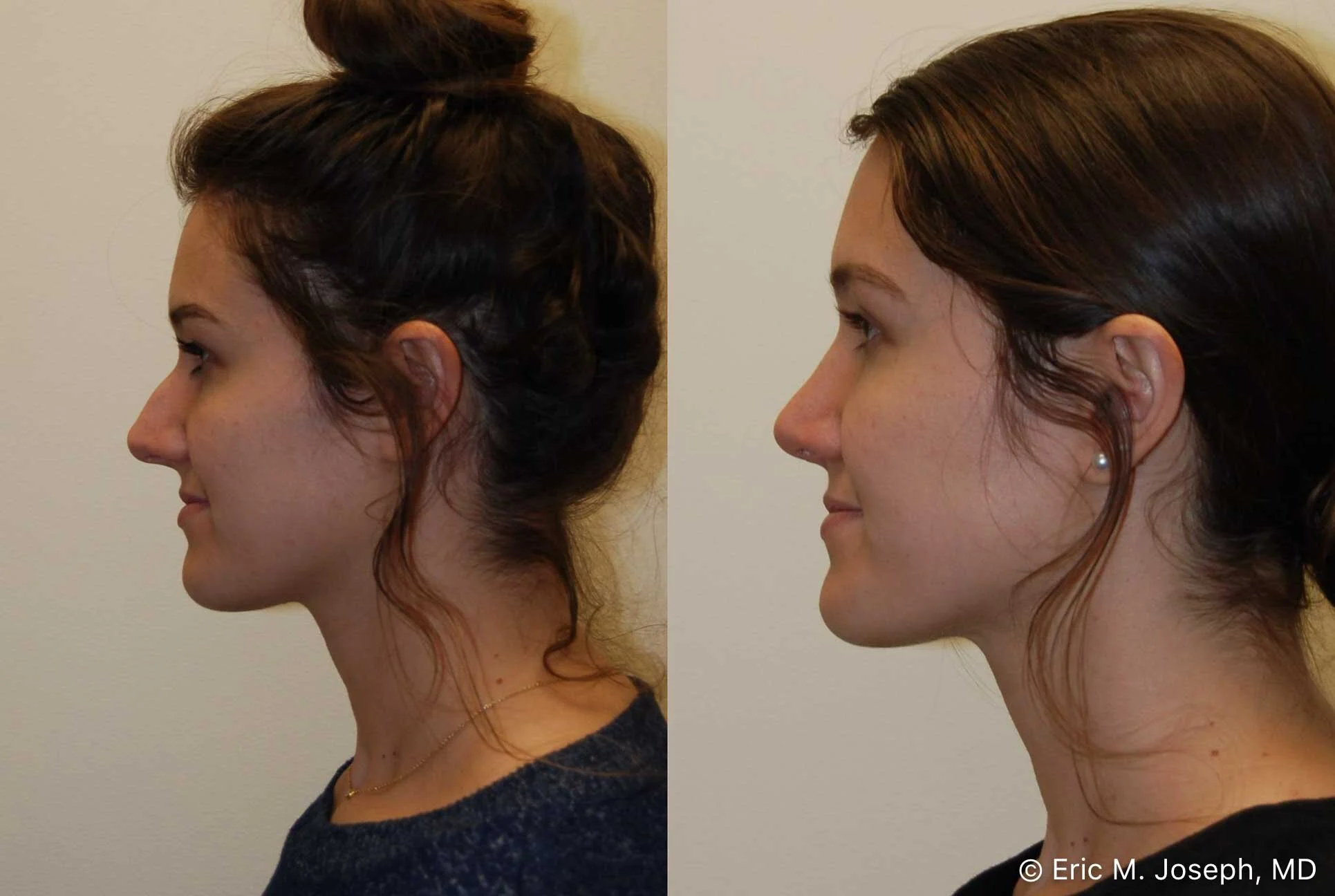 rhinoplasty-nj-nose-job-new-jersey-0573.jpg