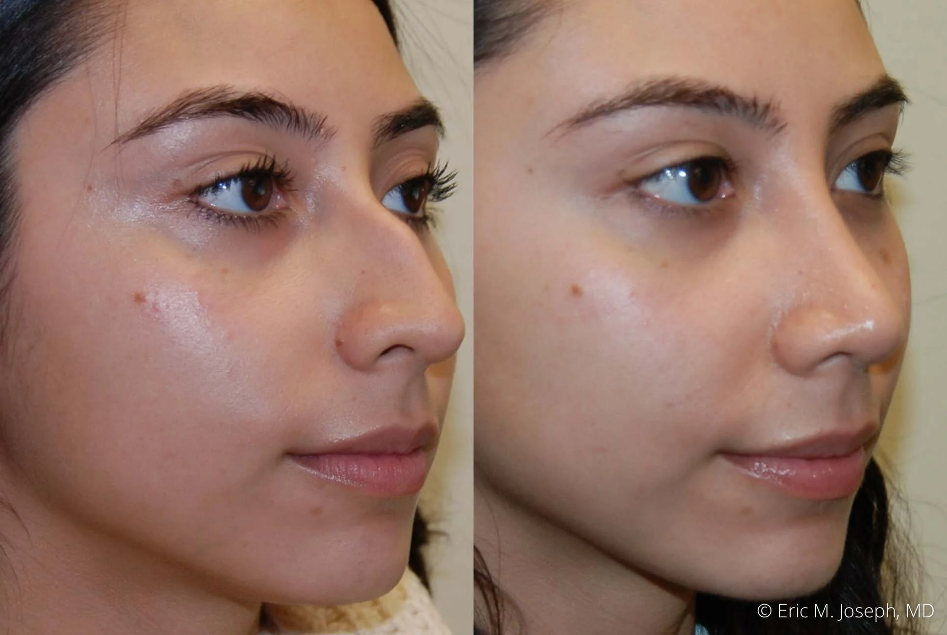 rhinoplasty-new-jersey-nyc-0533.jpg