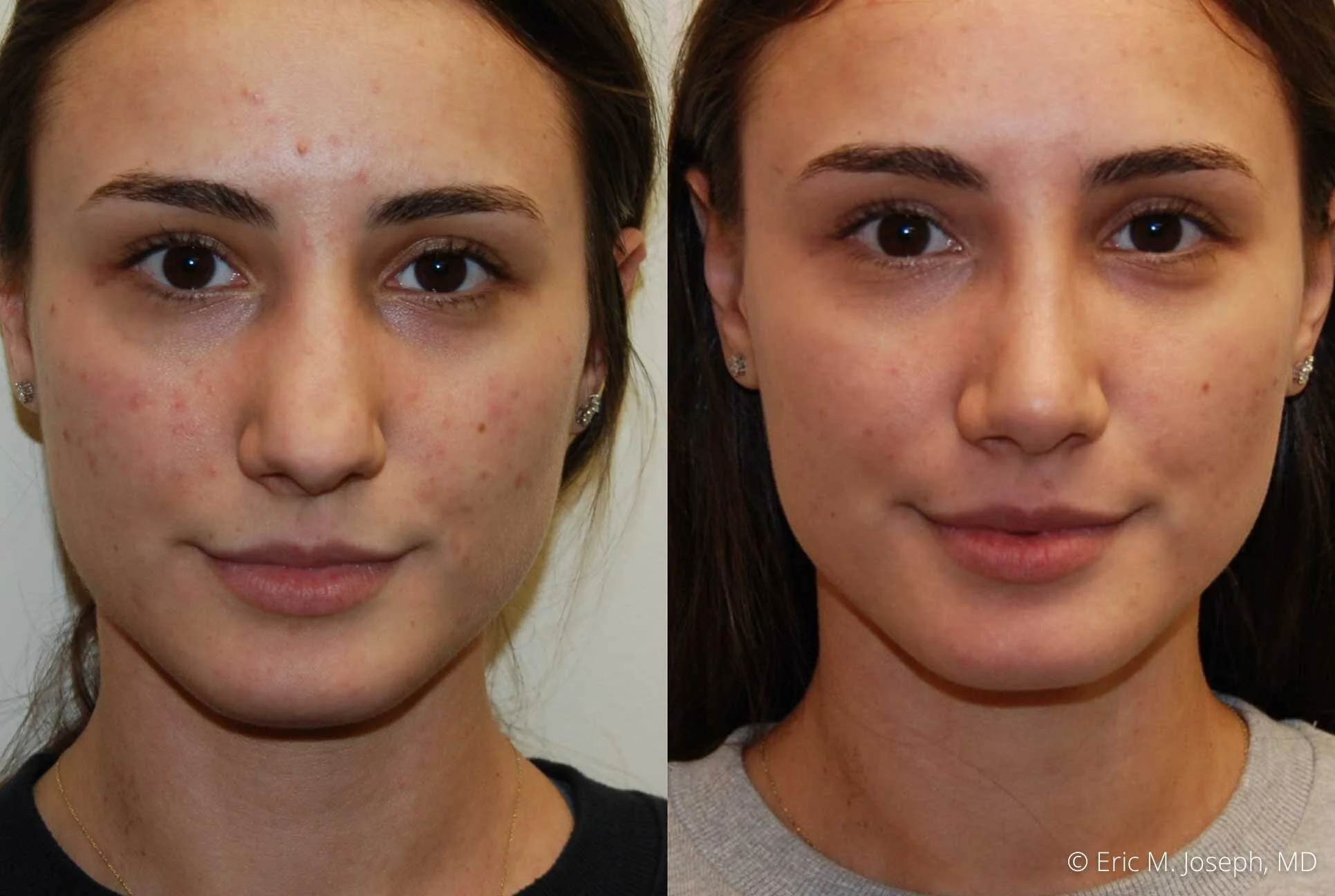 rhinoplasty-nj-nose-job-new-jersey-0590.jpg