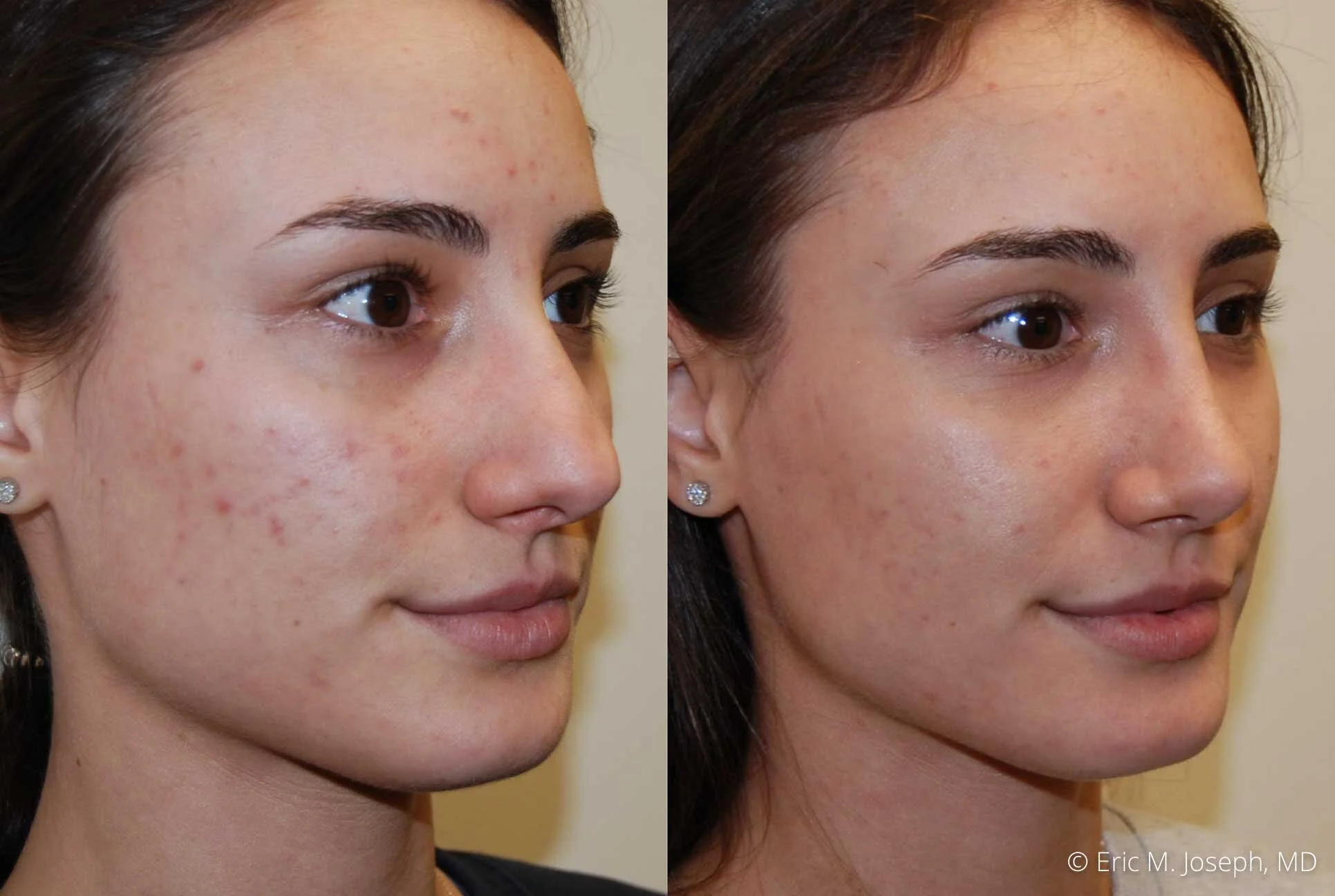 rhinoplasty-nj-nose-job-new-jersey-0591.jpg