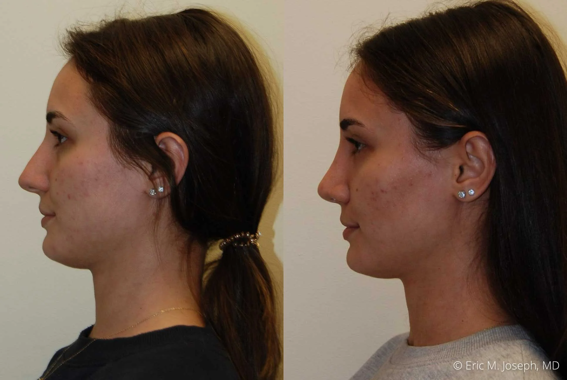 rhinoplasty-nj-nose-job-new-jersey-0593.jpg