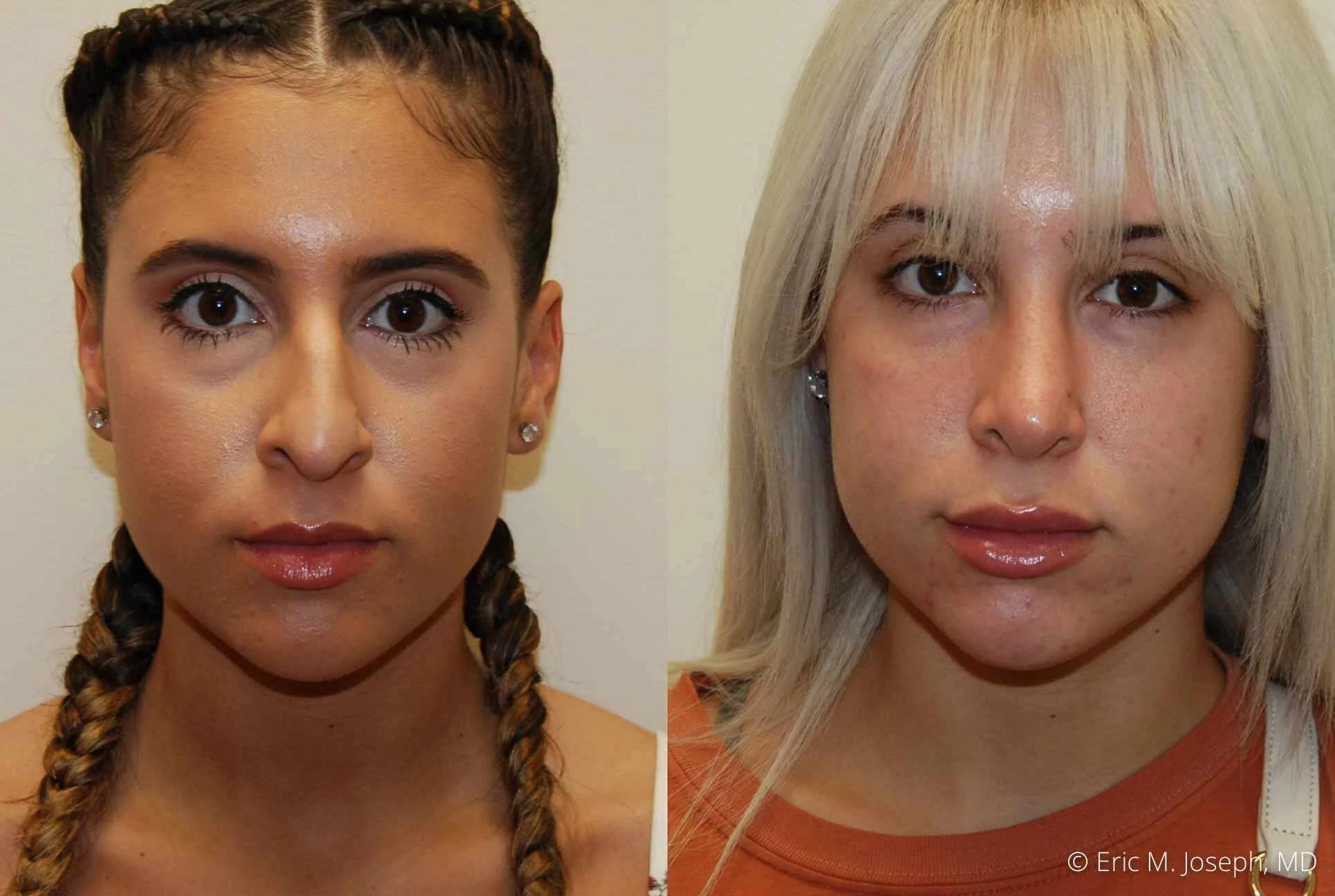 rhinoplasty-nj-nose-job-new-jersey-0608.jpg