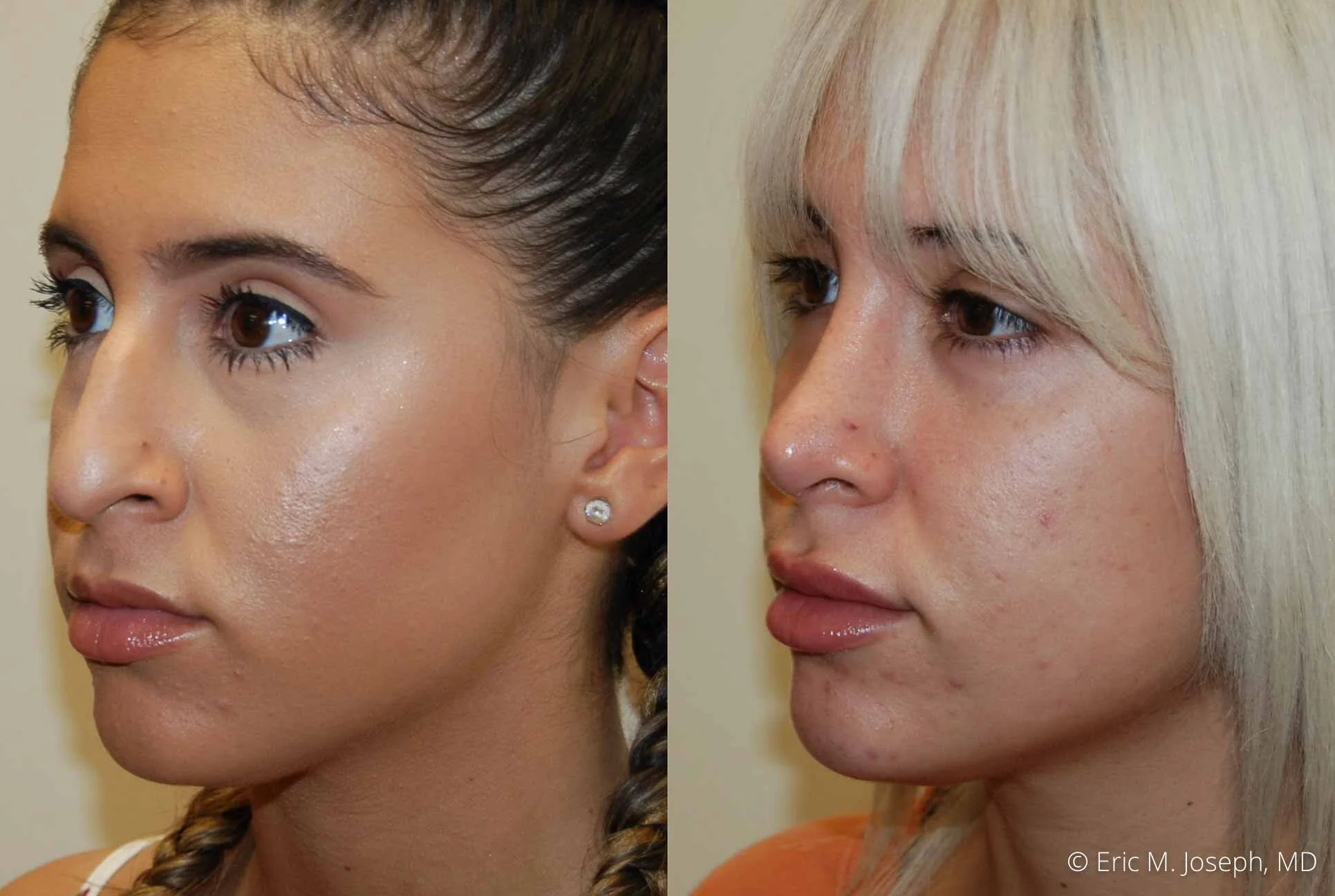 rhinoplasty-nj-nose-job-new-jersey-0610.jpg