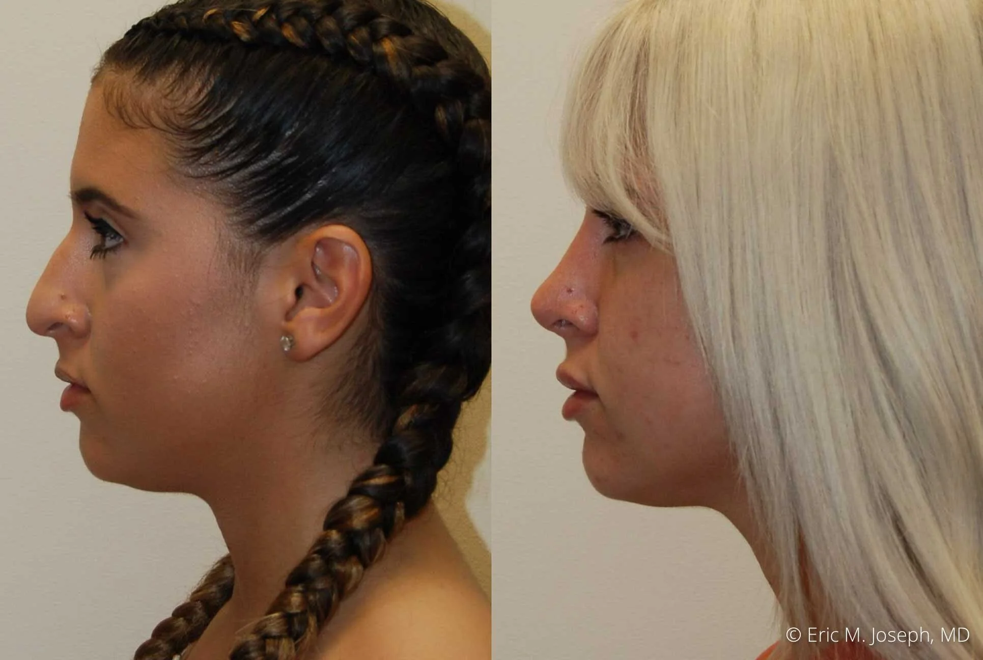 rhinoplasty-nj-nose-job-new-jersey-0611.jpg