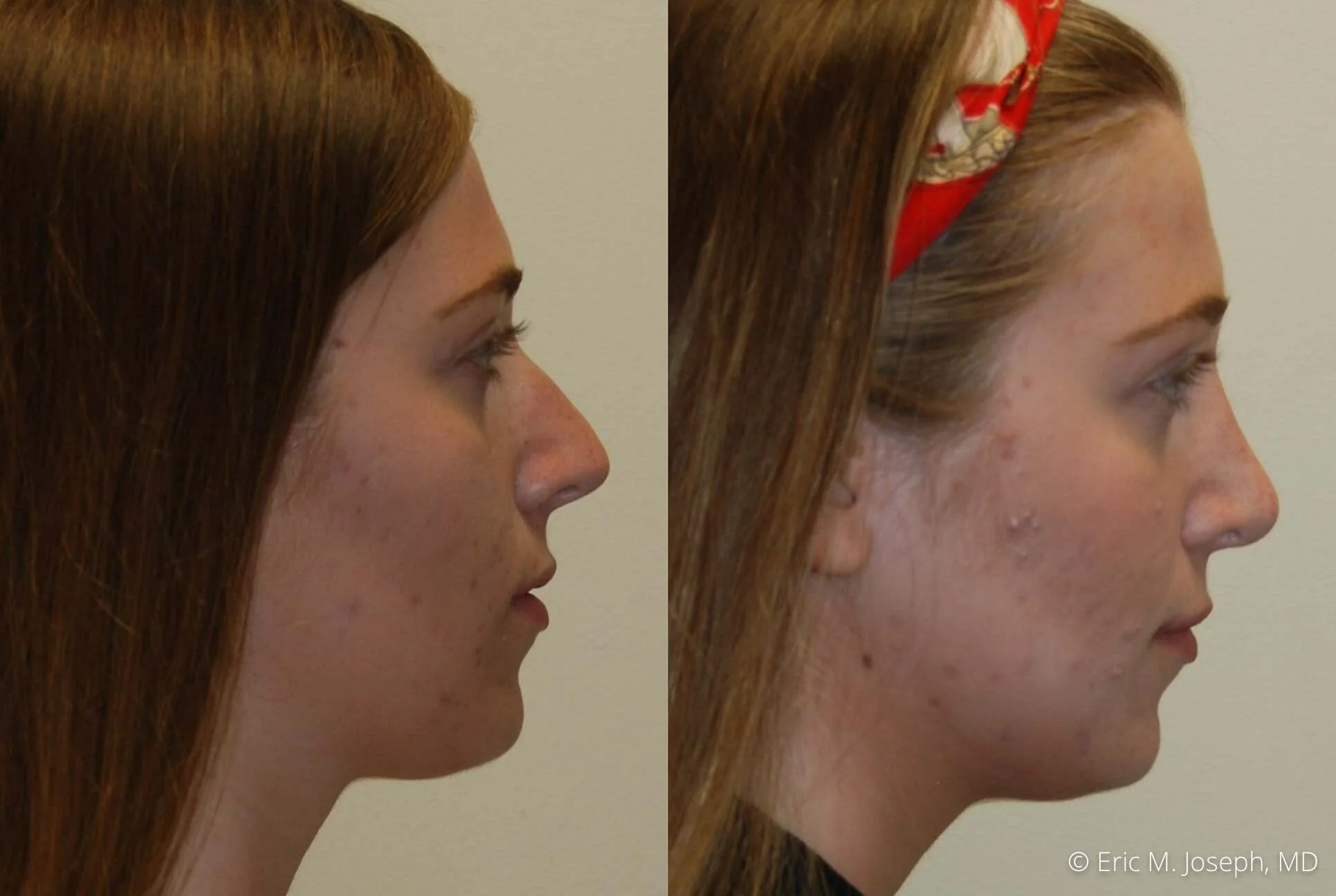 rhinoplasty-nj-nose-job-new-jersey-0600.jpg