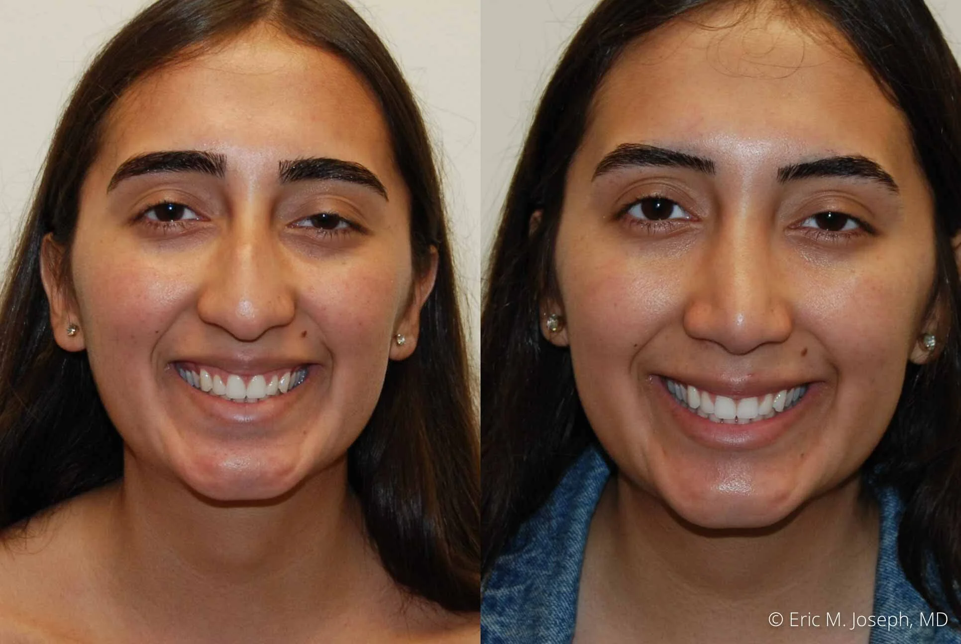 rhinoplasty-nj-nose-job-new-jersey-0602.jpg