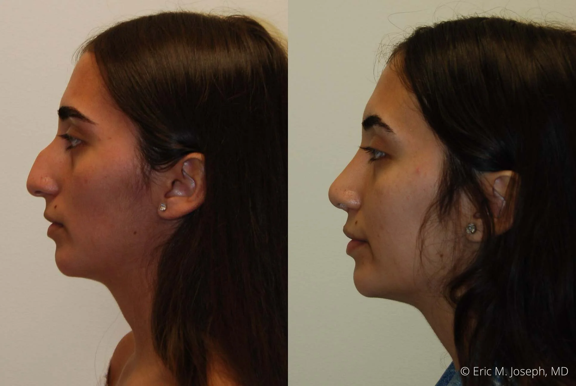 rhinoplasty-nj-nose-job-new-jersey-0605.jpg