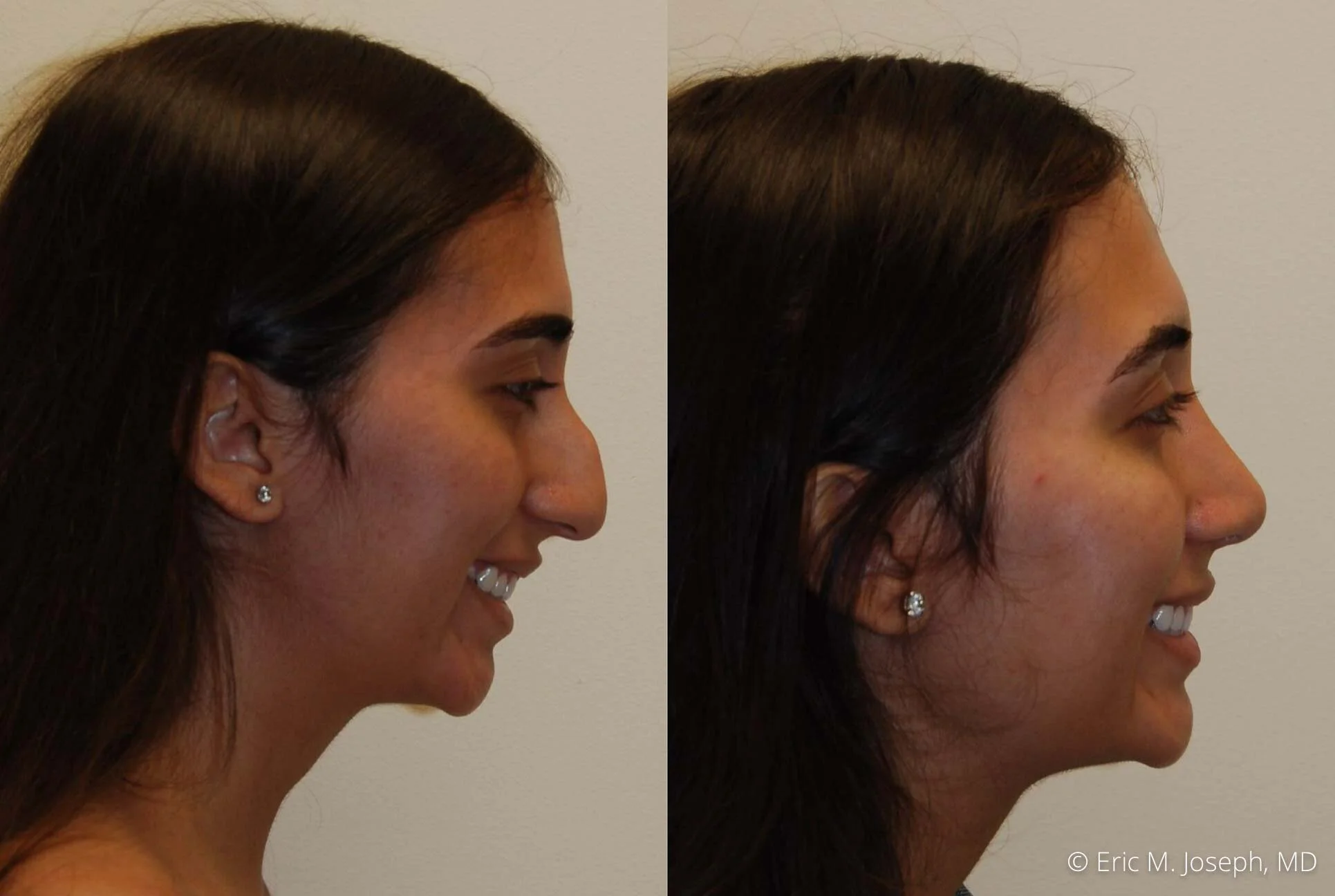 rhinoplasty-nj-nose-job-new-jersey-0607.jpg