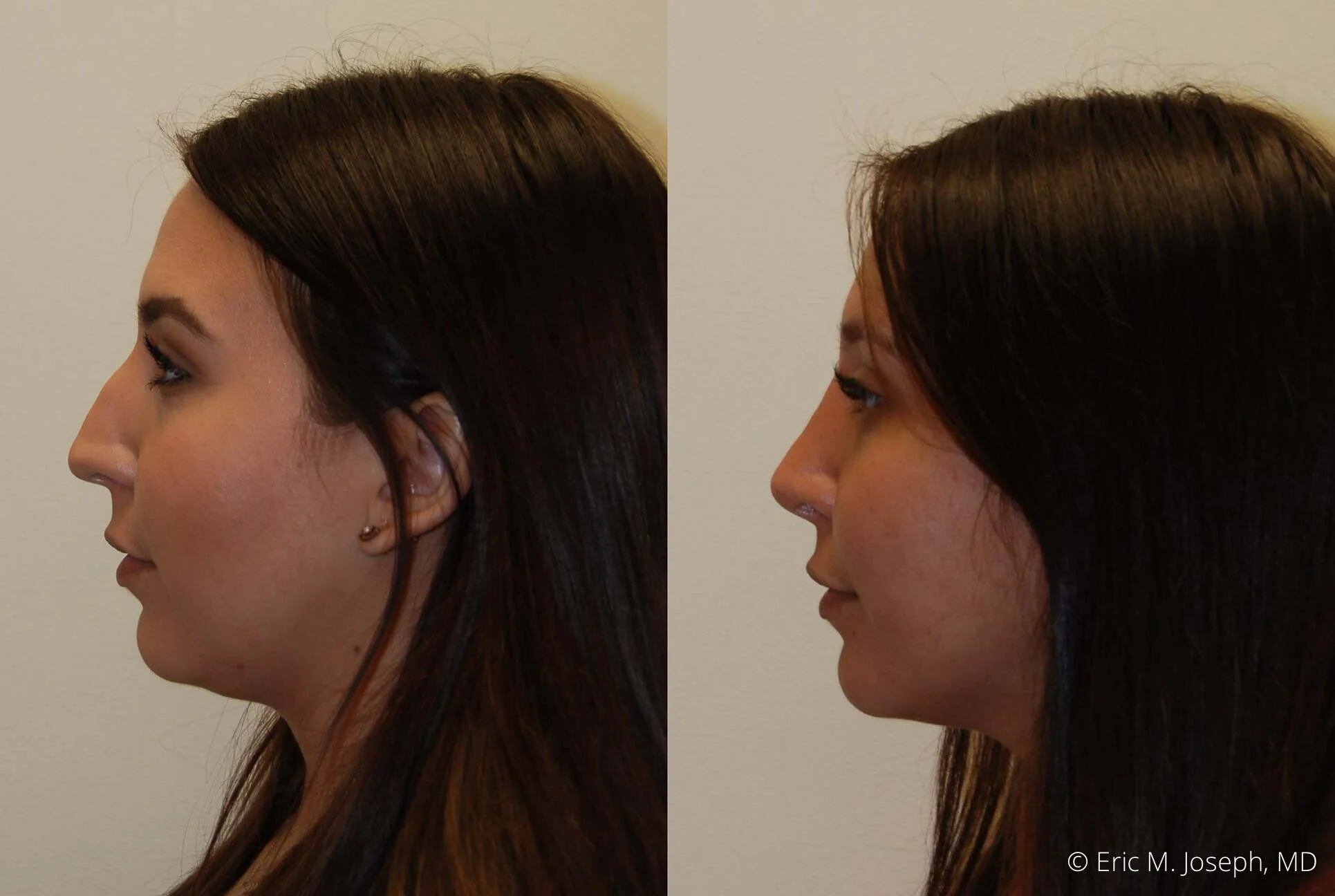 rhinoplasty-nj-nose-job-new-jersey-0604.jpg