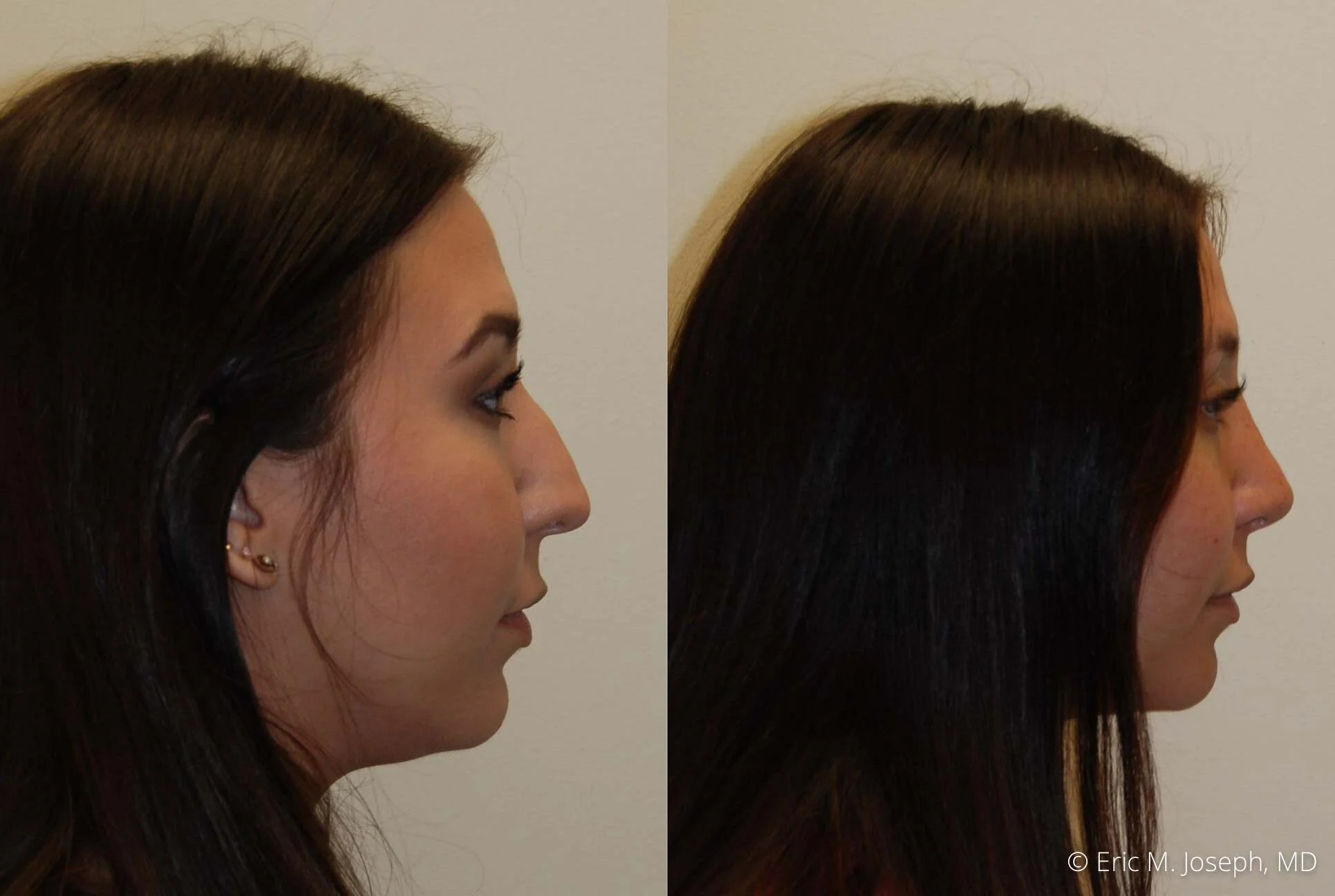 rhinoplasty-nj-nose-job-new-jersey-0605.jpg
