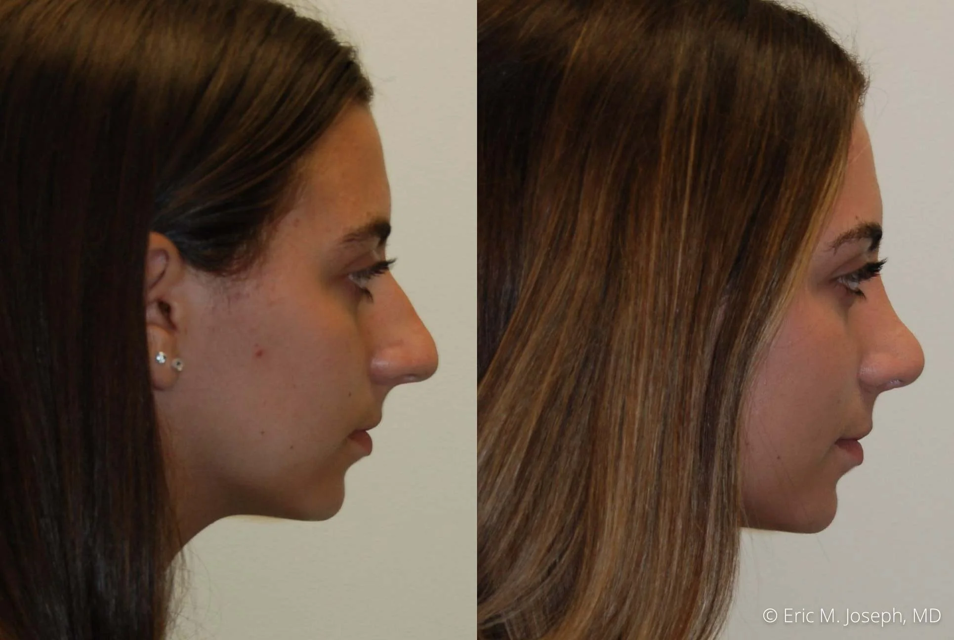 rhinoplasty-nj-nose-job-new-jersey-0615.jpg