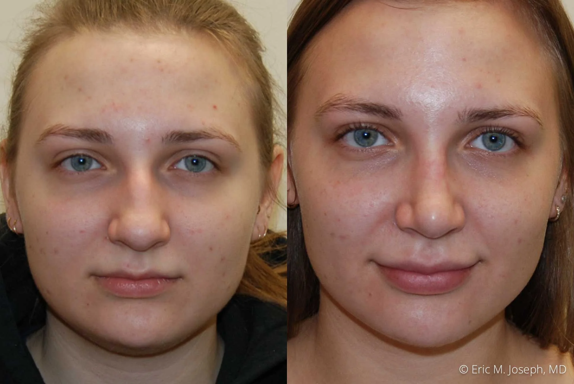rhinoplasty-nj-nose-job-new-jersey-0606.jpg