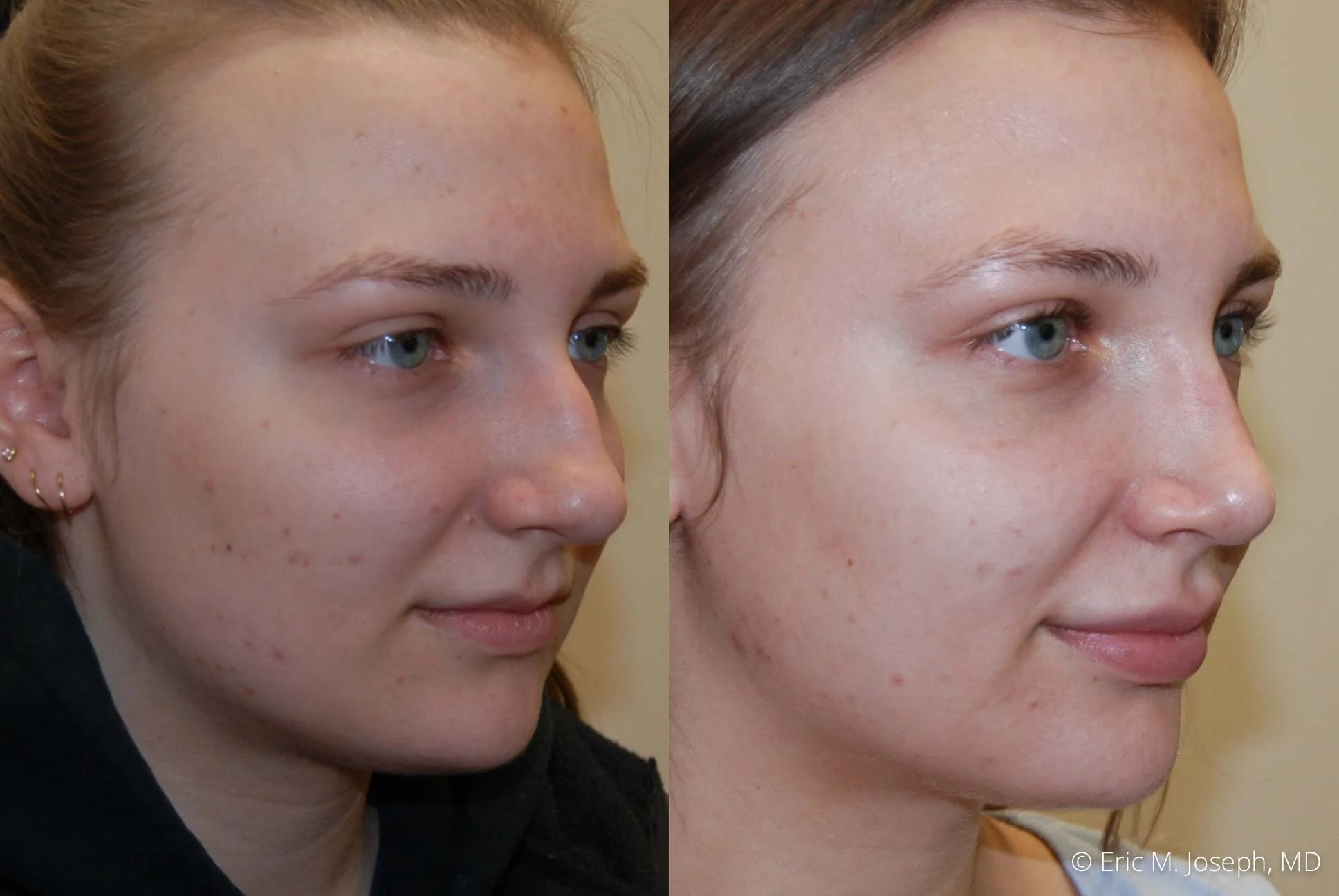 rhinoplasty-nj-nose-job-new-jersey-0607.jpg