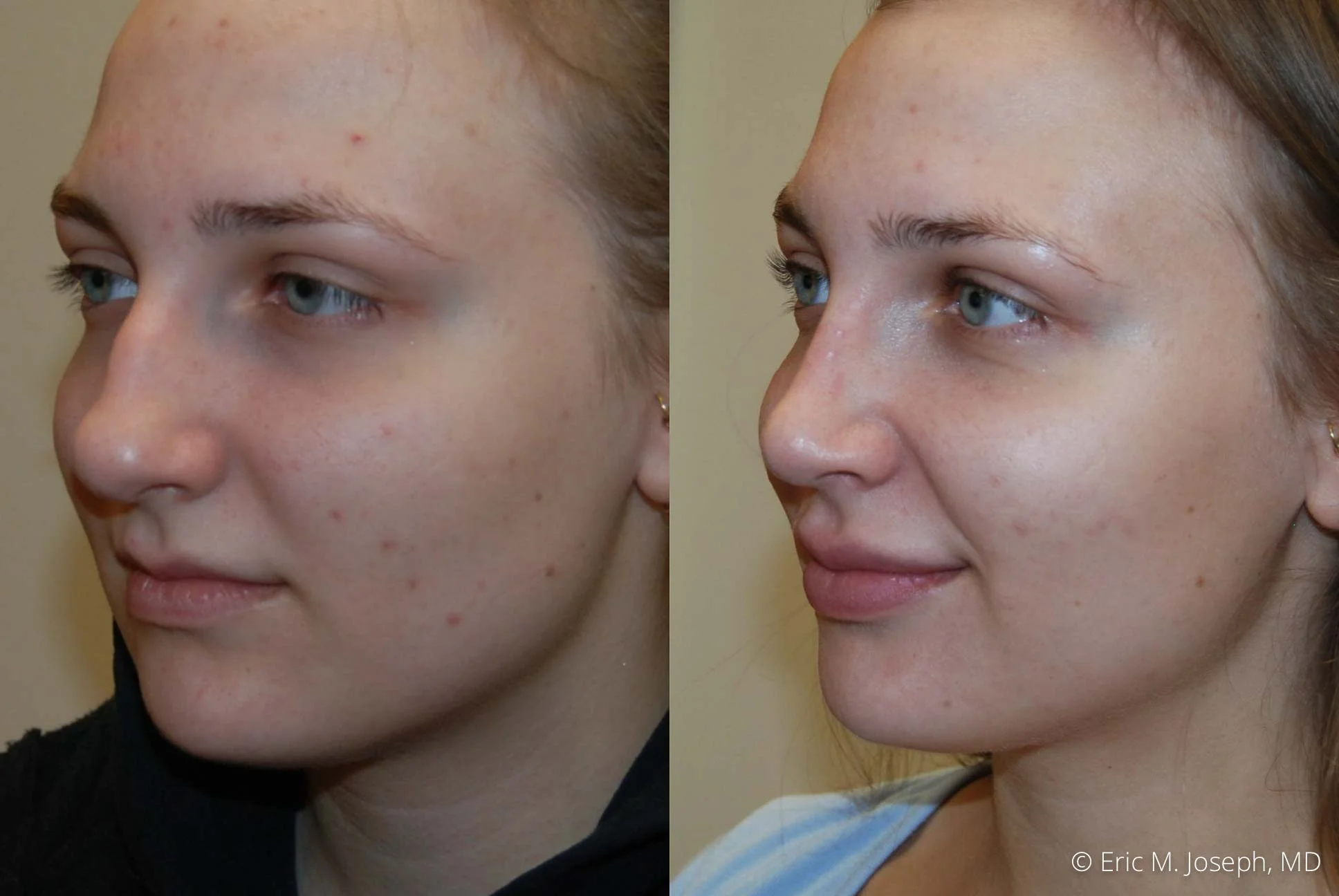 rhinoplasty-nj-nose-job-new-jersey-0608.jpg