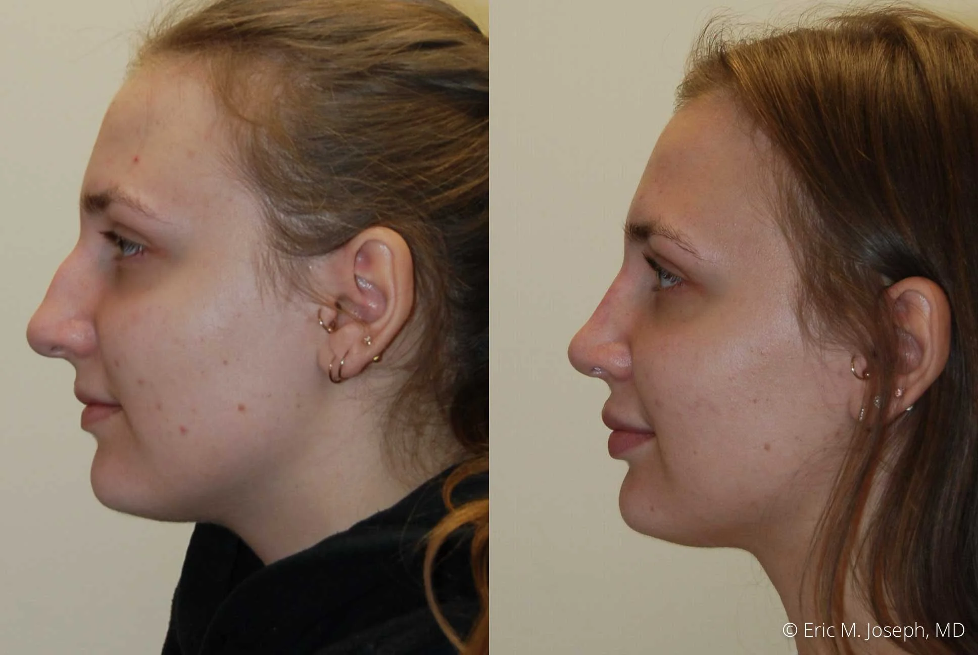 rhinoplasty-nj-nose-job-new-jersey-0609.jpg