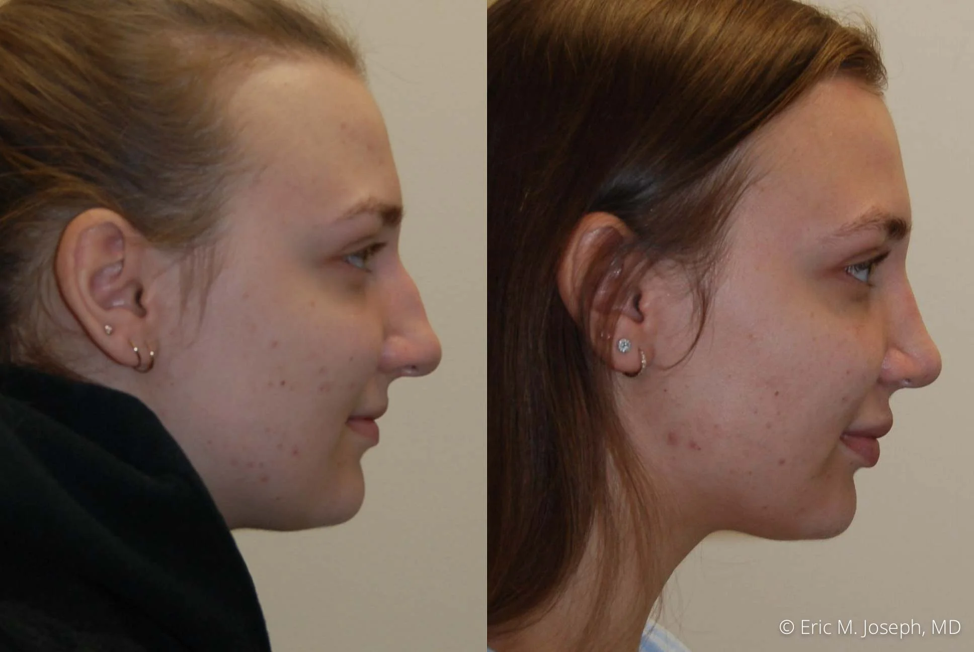 rhinoplasty-nj-nose-job-new-jersey-0610.jpg
