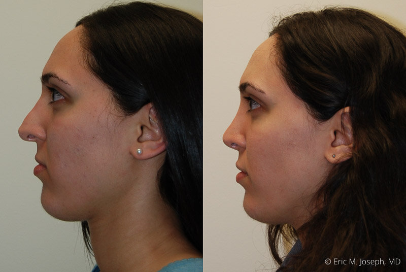 RevisionRhinoplasty-0047.jpg