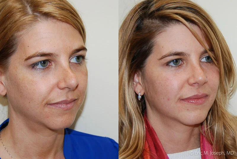 Eric M. Joseph, MD Revision Rhinoplasty Gallery