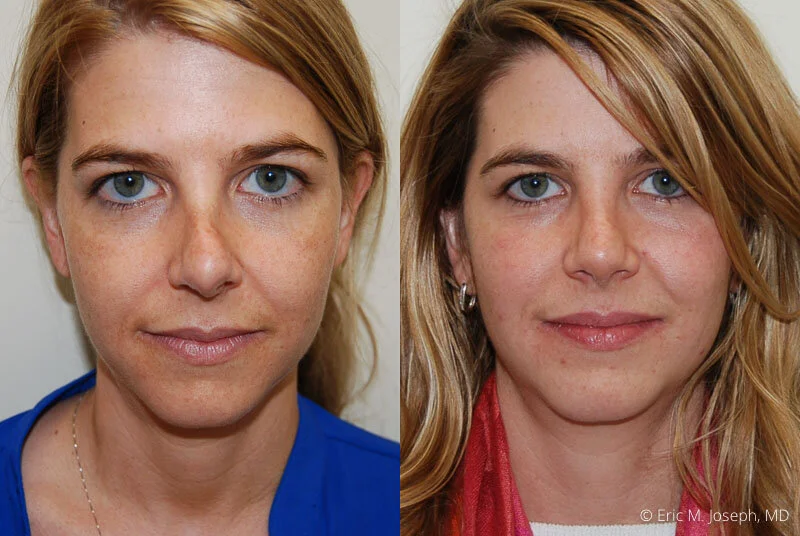 Eric M. Joseph, MD Revision Rhinoplasty Gallery