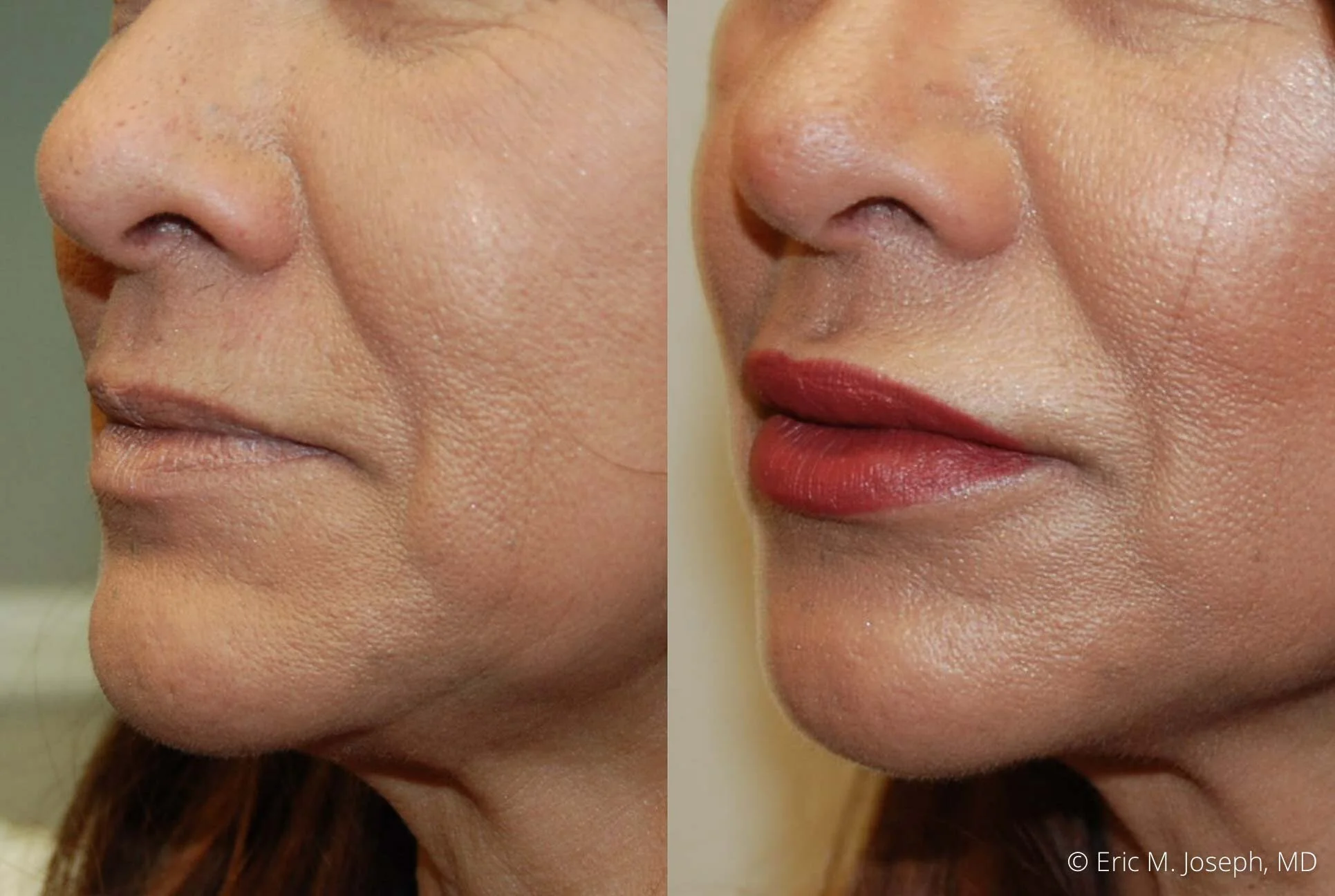 lip-augmentation-filler-permanent-nj-nyc-0064.jpg