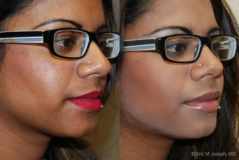 LipAugmentation-0019.jpg