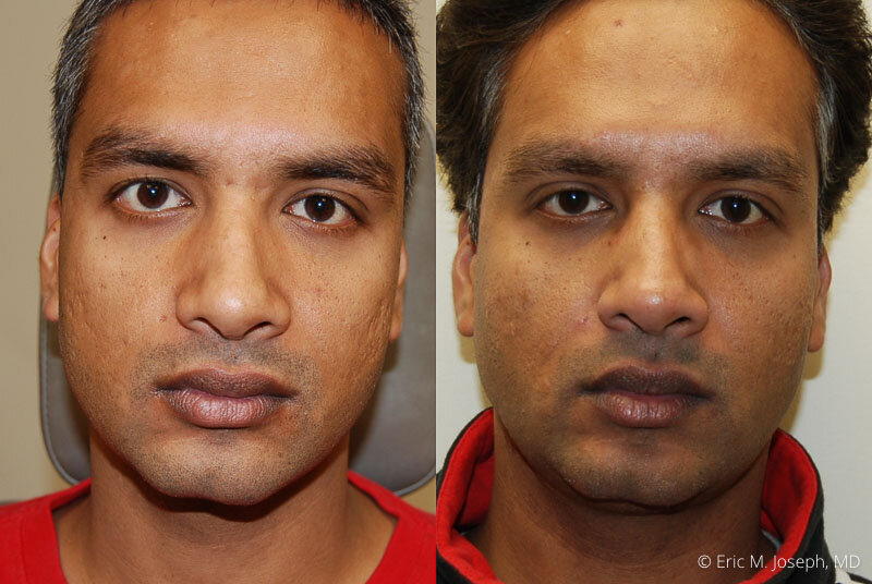 Eric M. Joseph, MD | Acne Scar Correction Before & After: 5 Years After  Treatment