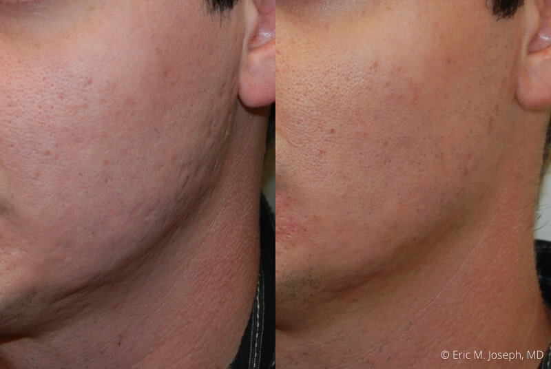 Acne Scars Before & After Photos New Jersey