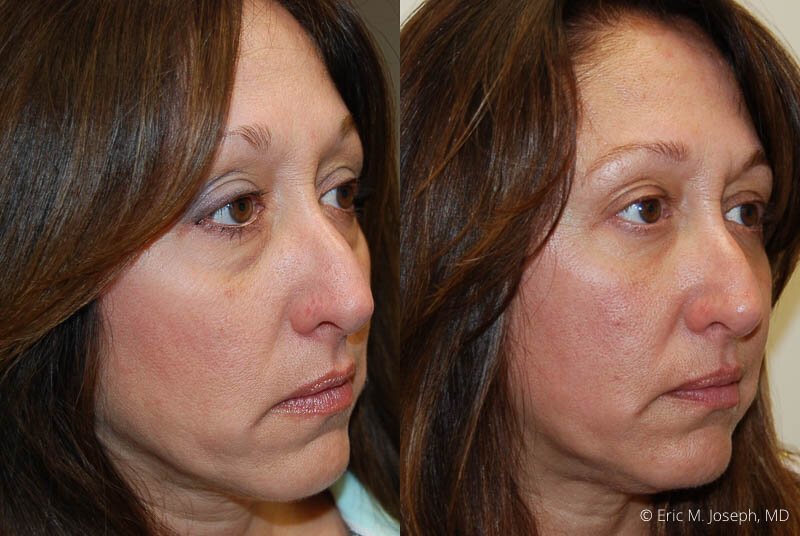 FacialRejuvenation-0030.jpg