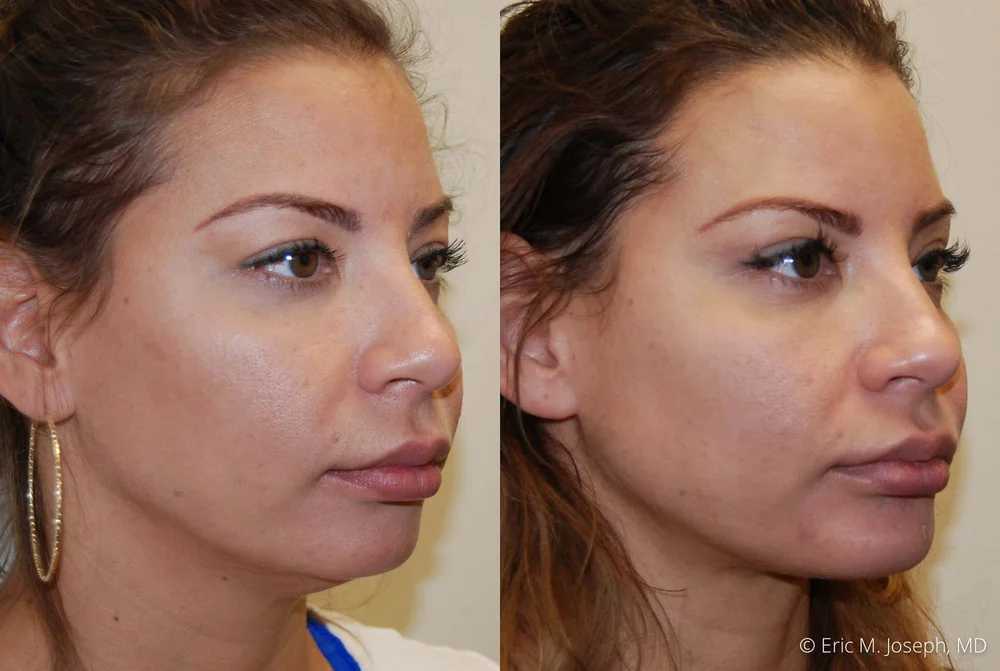 Chin Coloring