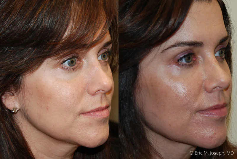 Joe Botox Eric M. Joseph, MD | Botox Before & After: Smoother Forehead Appearance ...