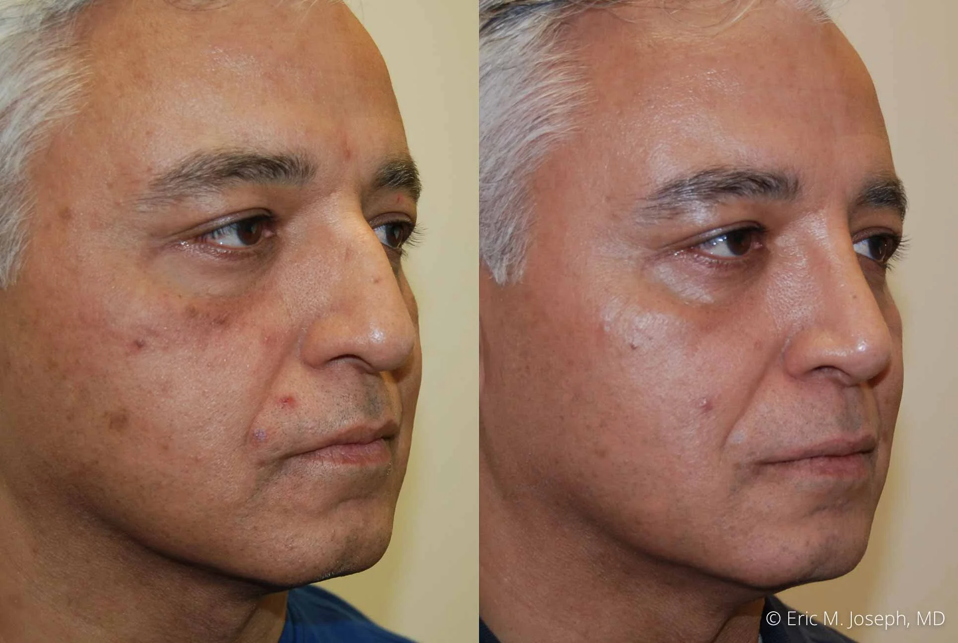one year post-op