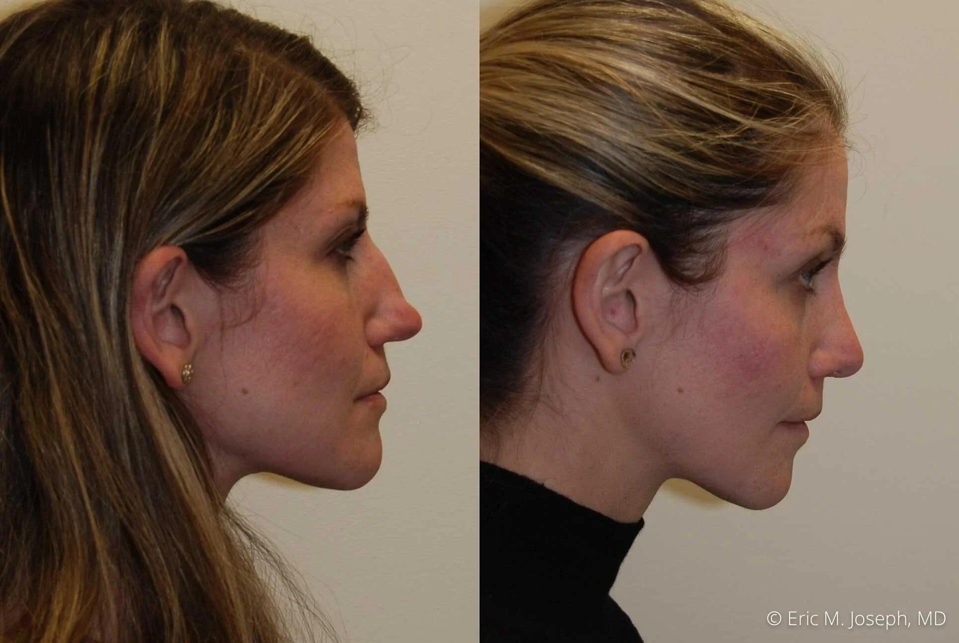 rhinoplasty-primary-0648.jpg