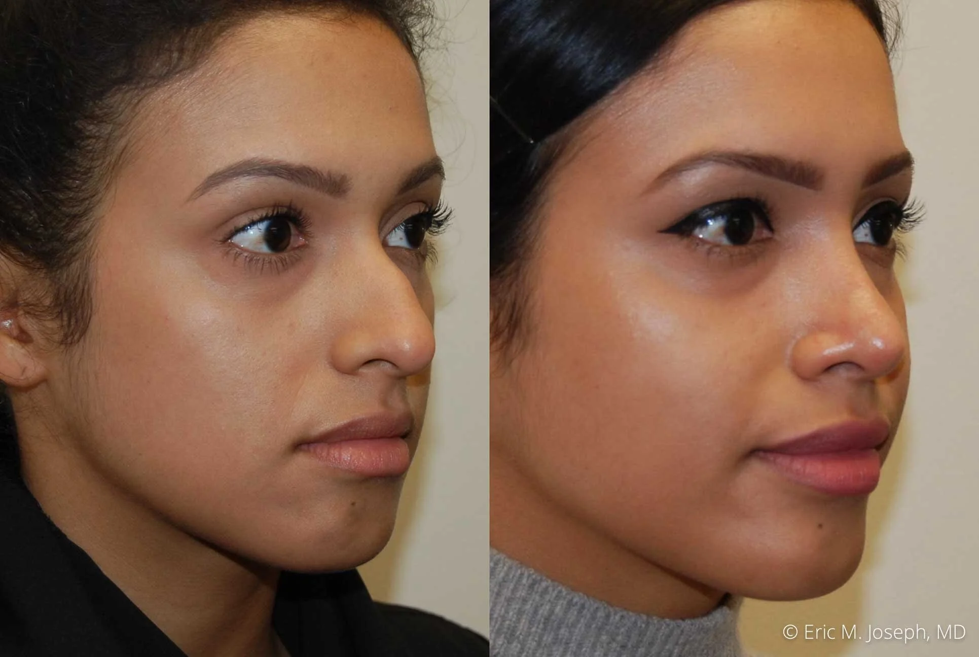 Eric M. Joseph, MD NJ Rhinoplasty Specialist New