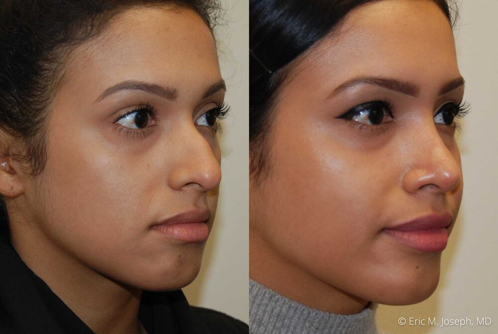 Rhinoplasty