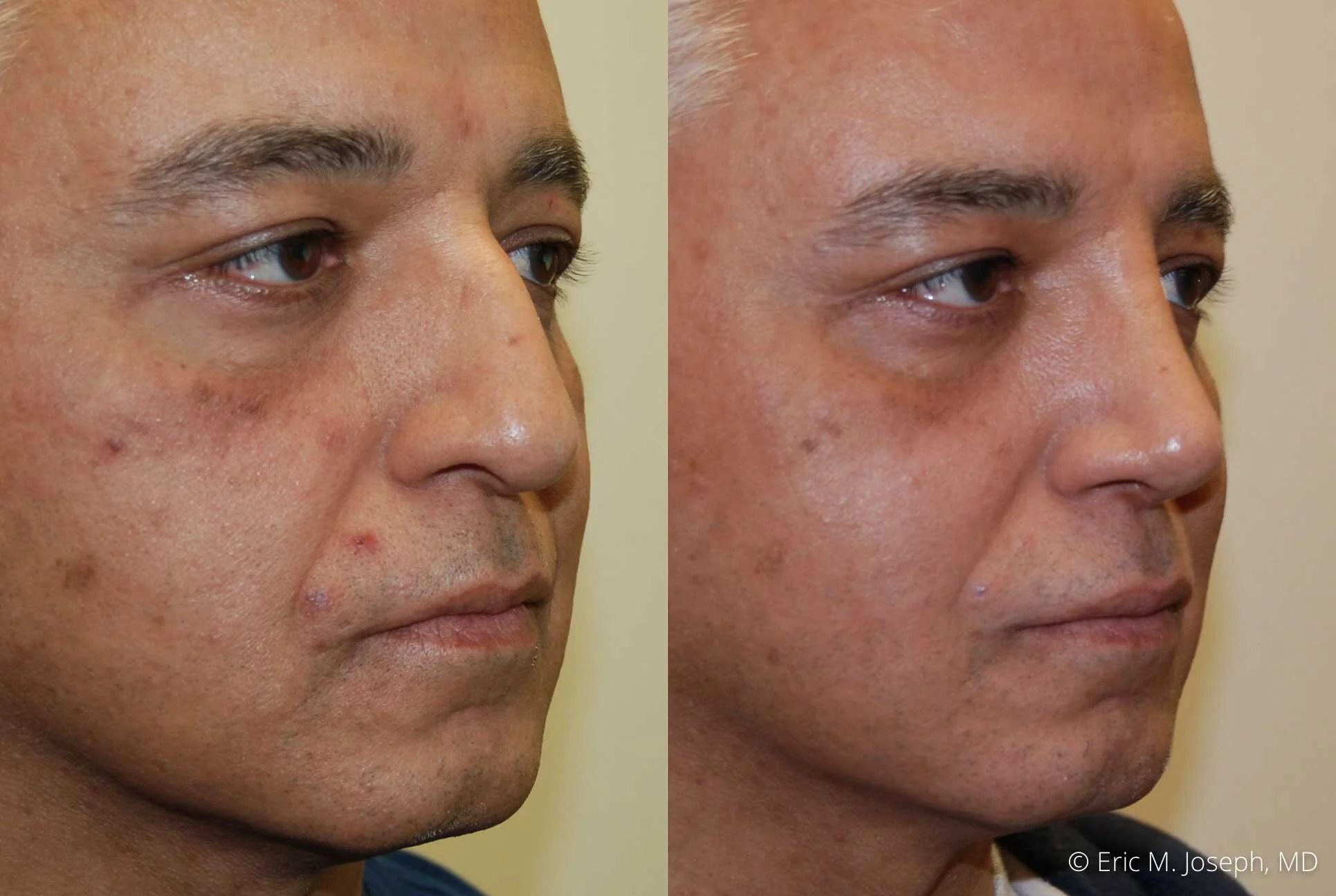Eric M. Joseph, MD NJ Rhinoplasty Specialist New