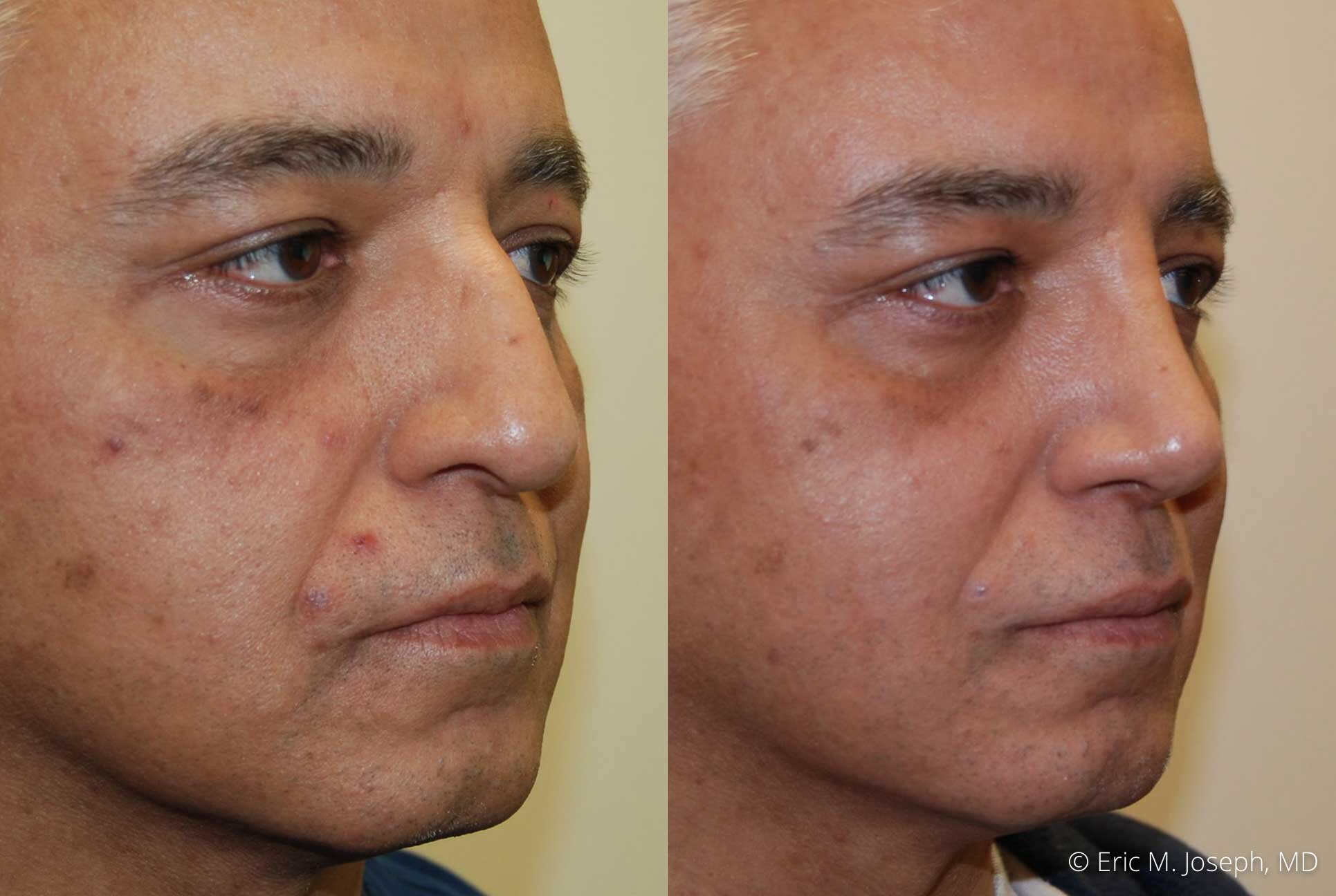 rhinoplasty-nj-0516.jpg