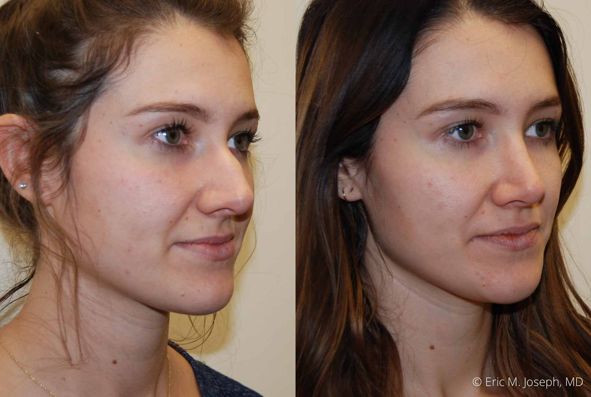 primary-rhinoplasty-nj-0695.jpg