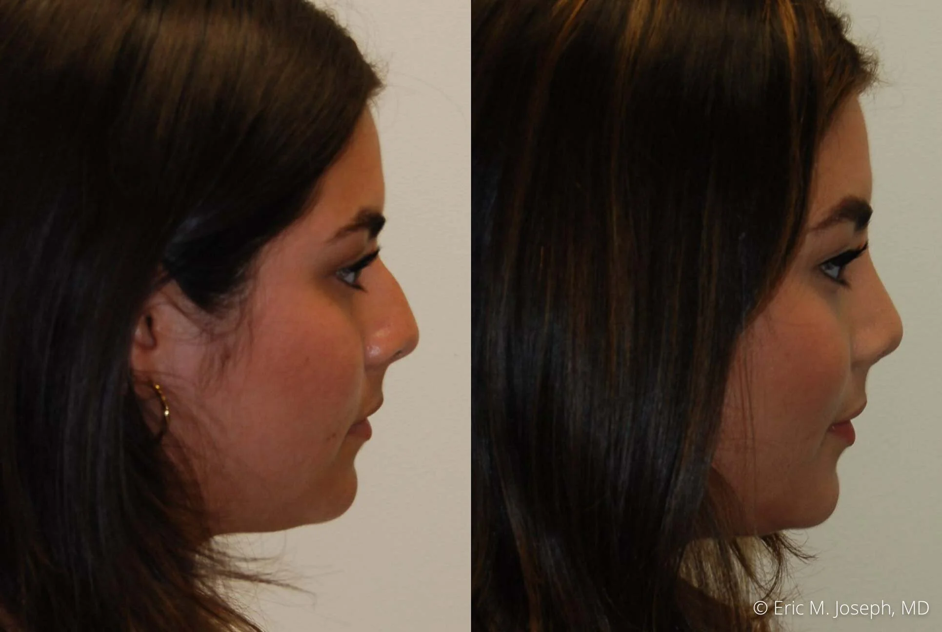 rhinoplasty-0805.jpg