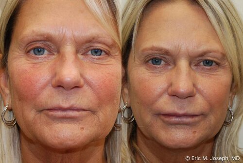 Eric M Joseph Md Silikon 1000 32