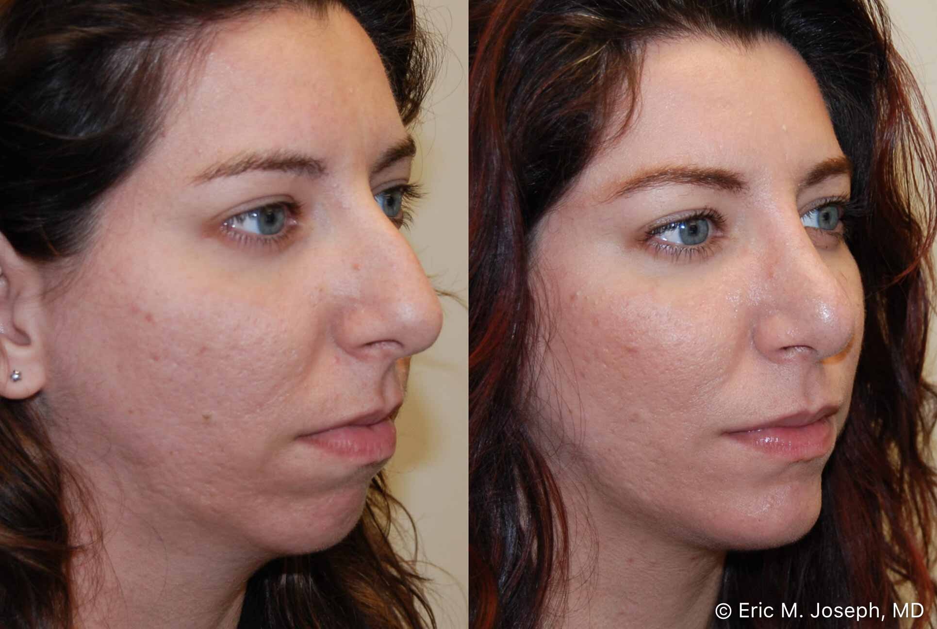 rhinoplasty-chin-implant-0883.jpg