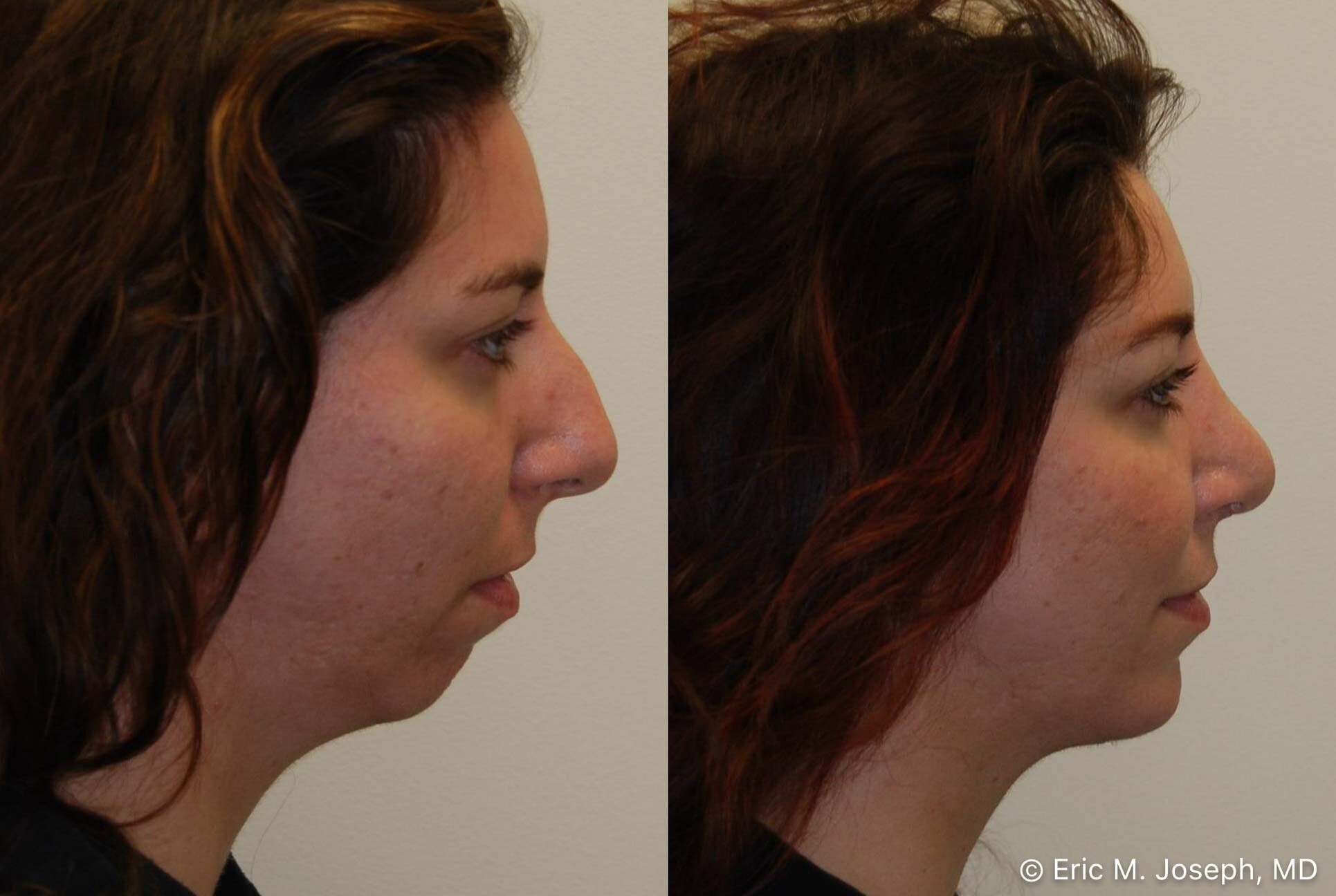 rhinoplasty-chin-implant-0886.jpg